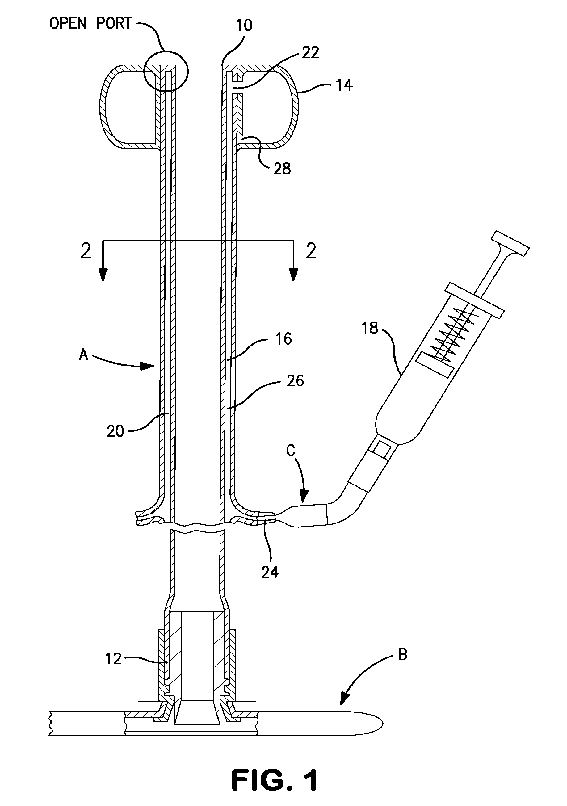 Apparatus for preventing over inflation of the retention balloon in medical catheters and airway devices