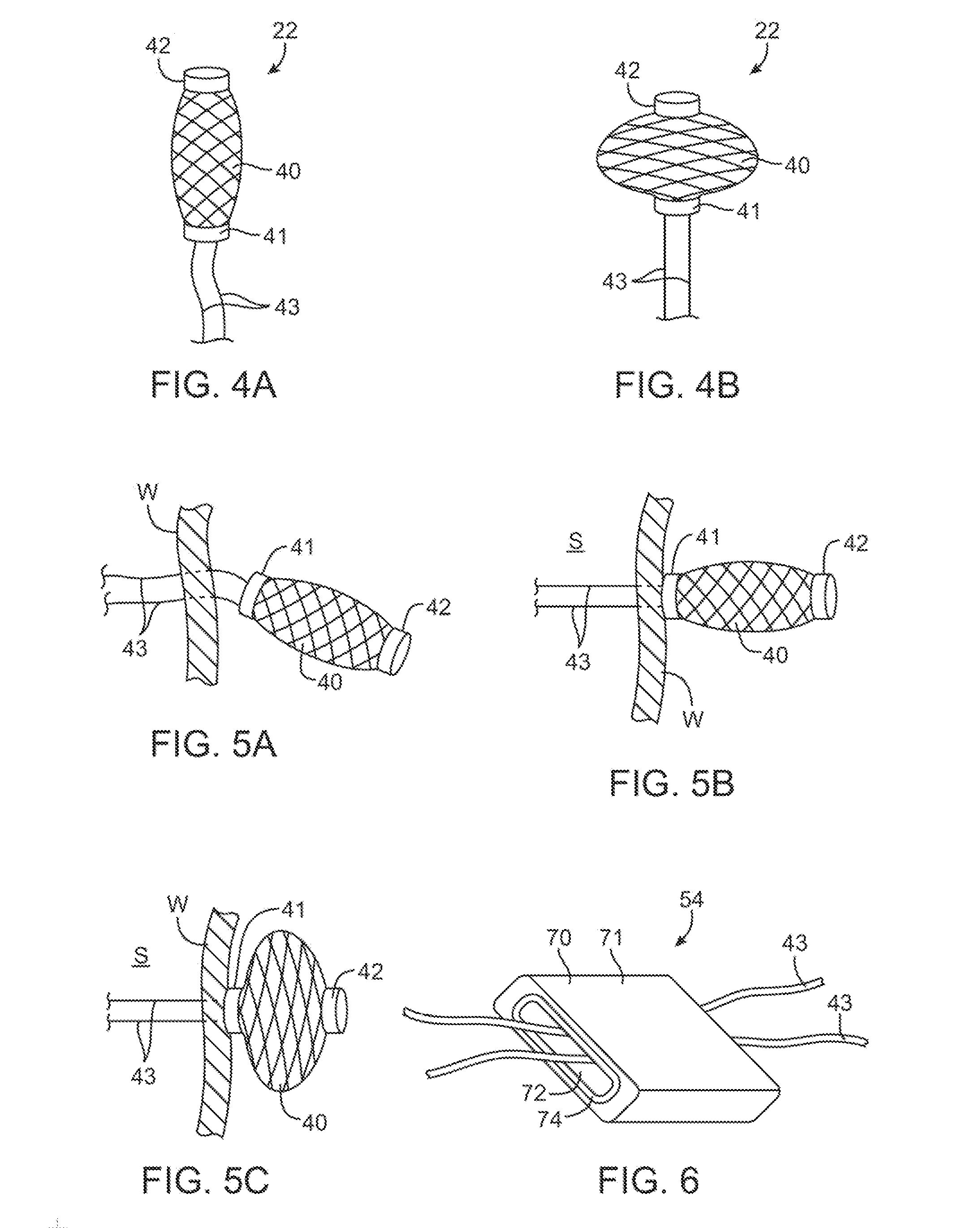 Delivery systems and methods for gastric reduction