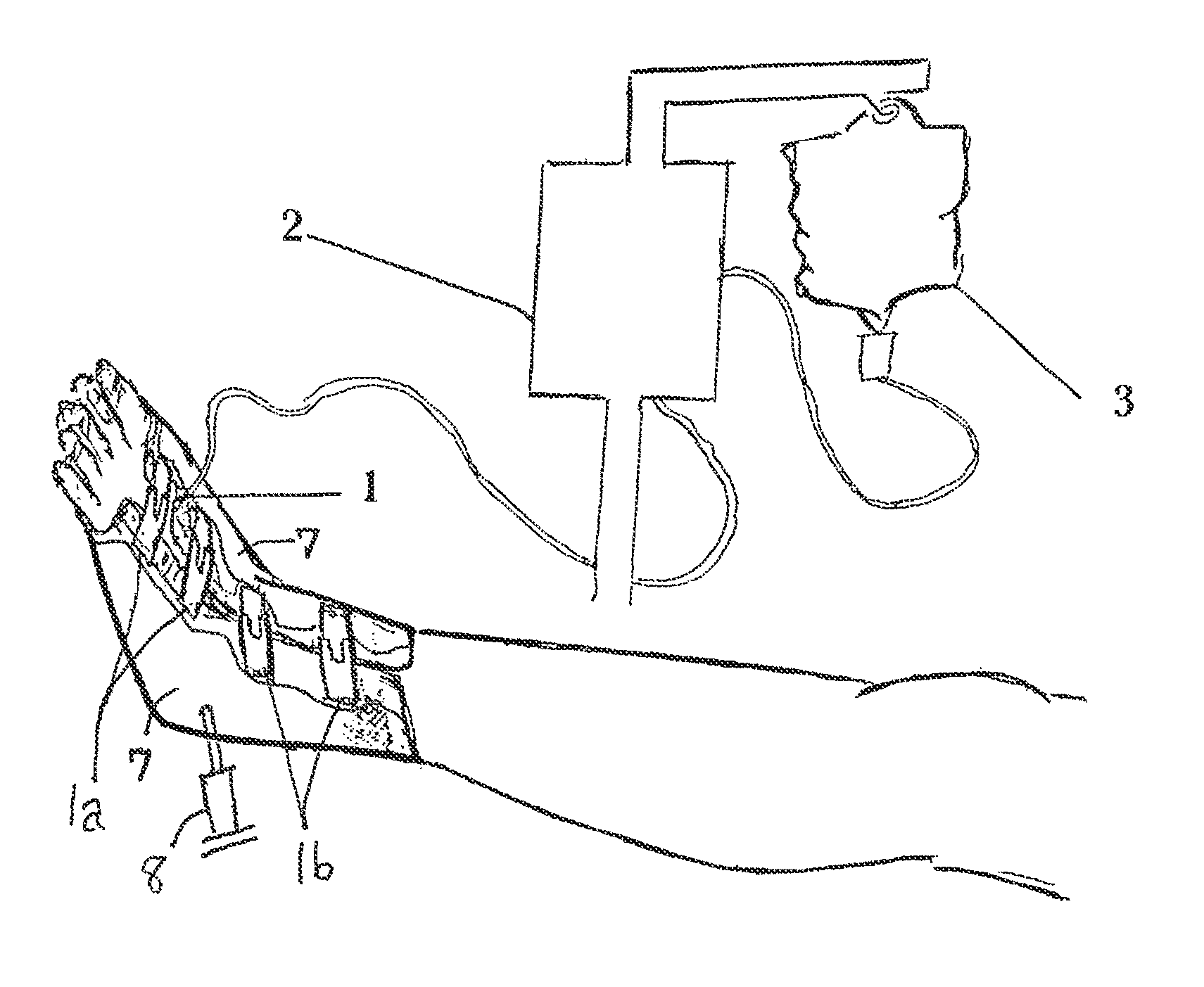 Device and method for prevention and treatment of deep venous thrombosis