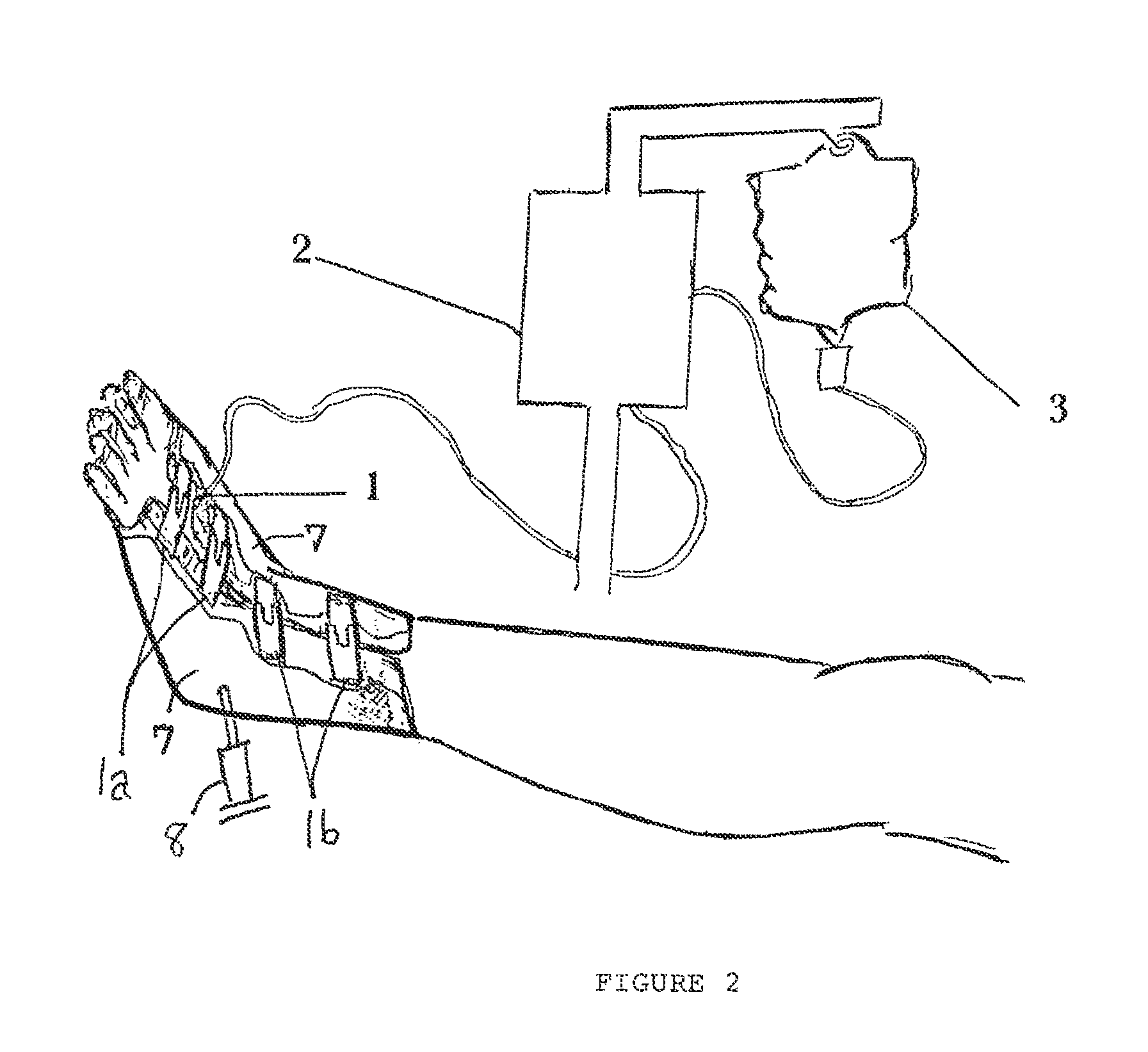 Device and method for prevention and treatment of deep venous thrombosis