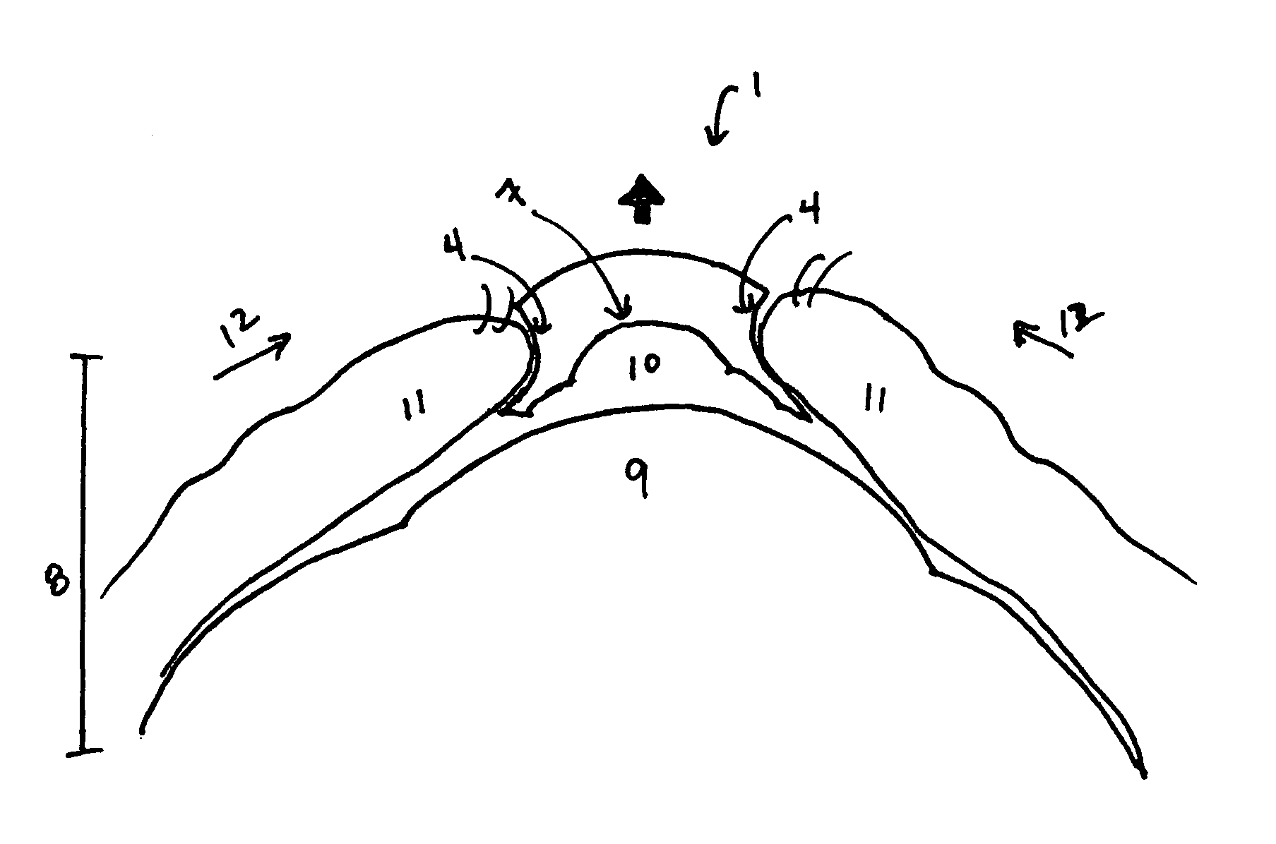 Accommodating or focusable contact lens