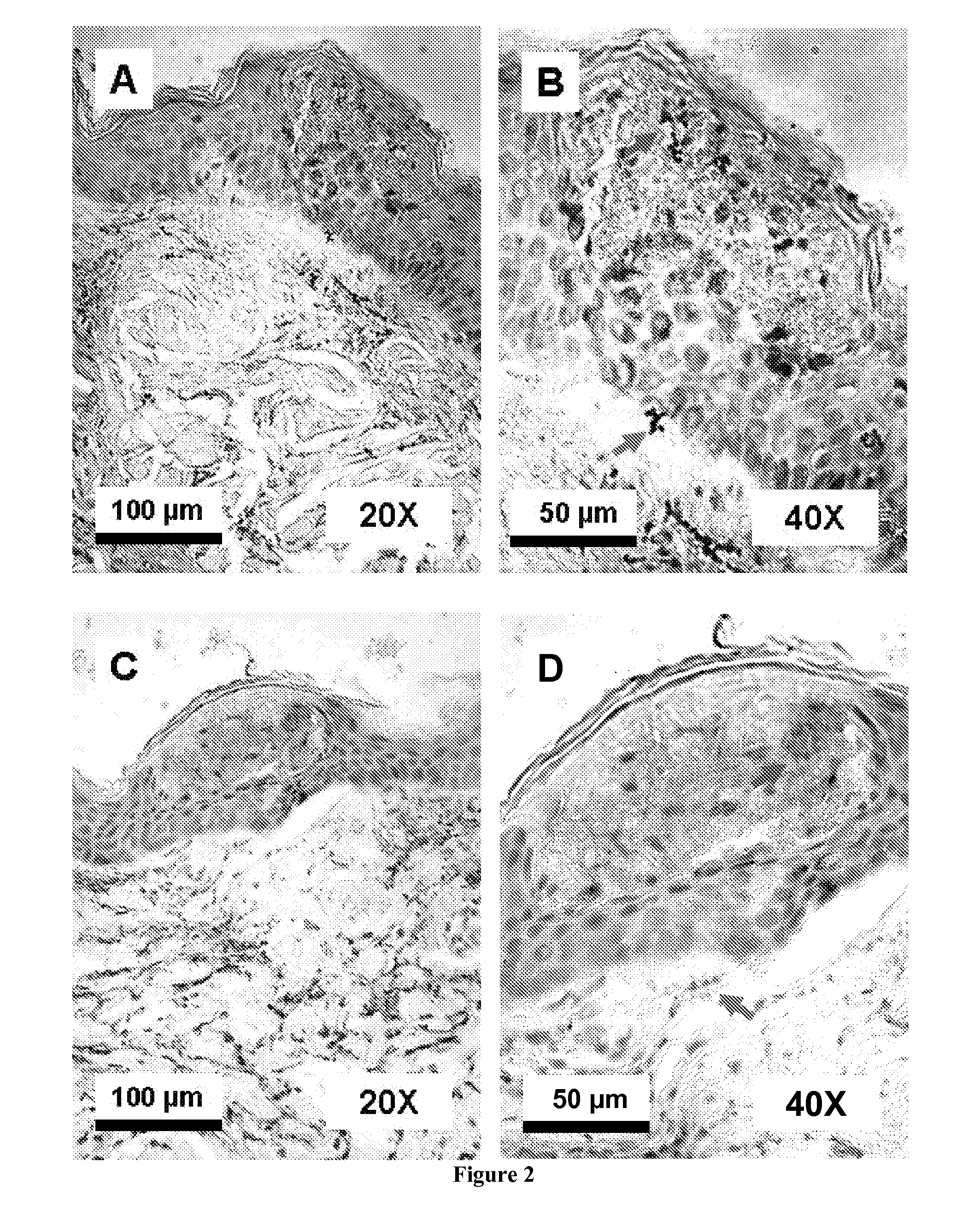 Laser-induced transepidermal elimination of content by fractional photothermolysis