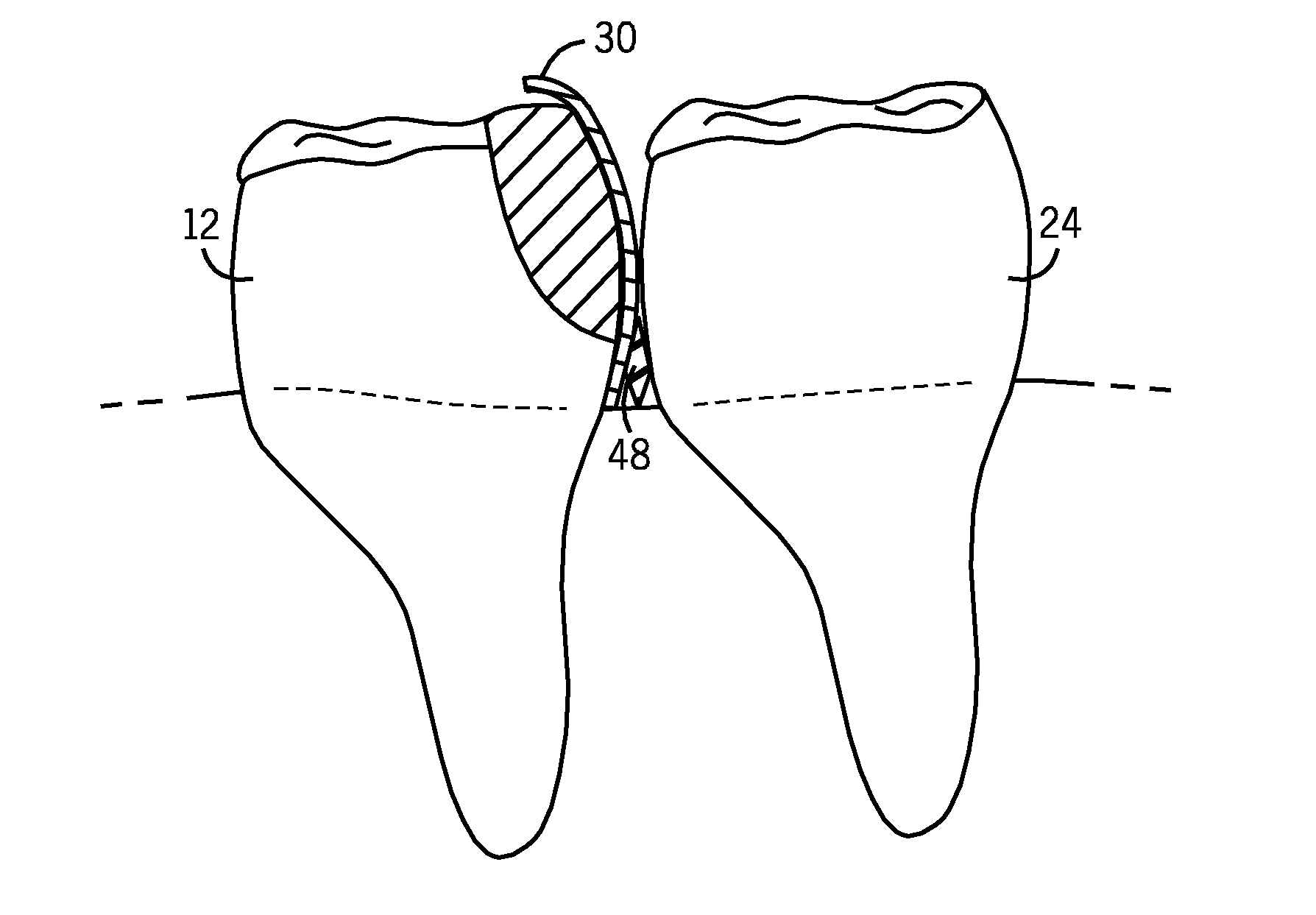 Matrix Stabilizer Devices And A Seamless, Single Load Cavity Preparation And Filling Technique