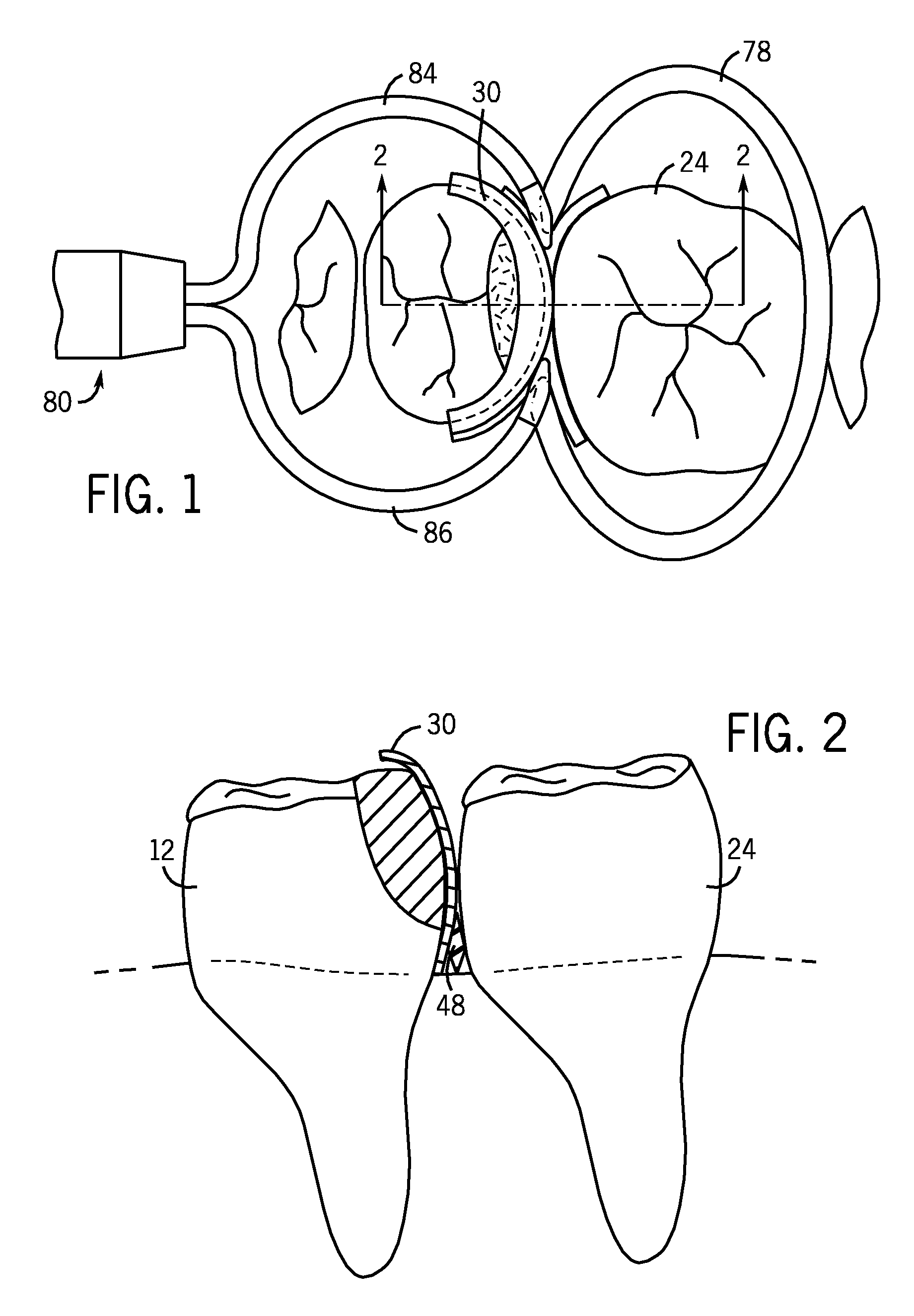 Matrix Stabilizer Devices And A Seamless, Single Load Cavity Preparation And Filling Technique