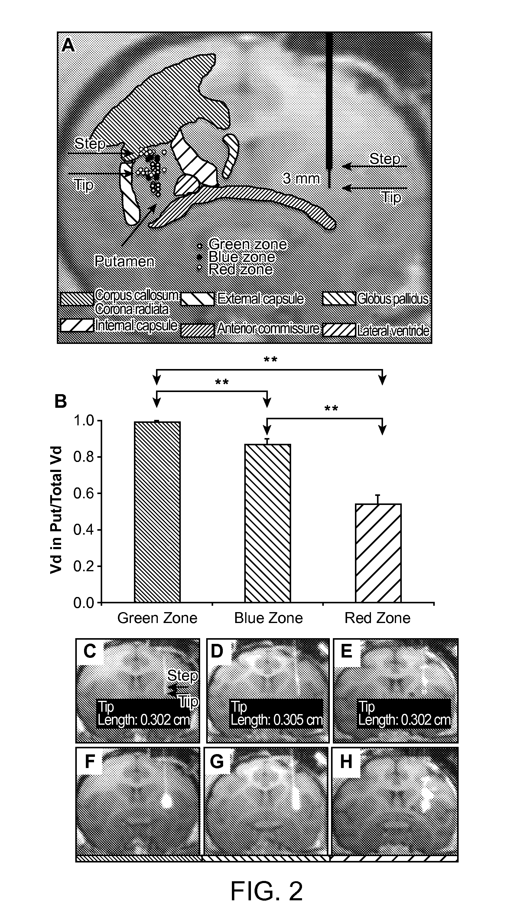 Optimized Placement of Cannula for Delivery of Therapeutics to the Brain