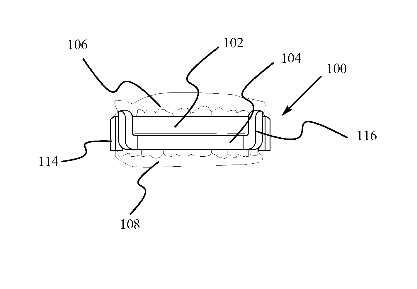 Mandibular advancement device