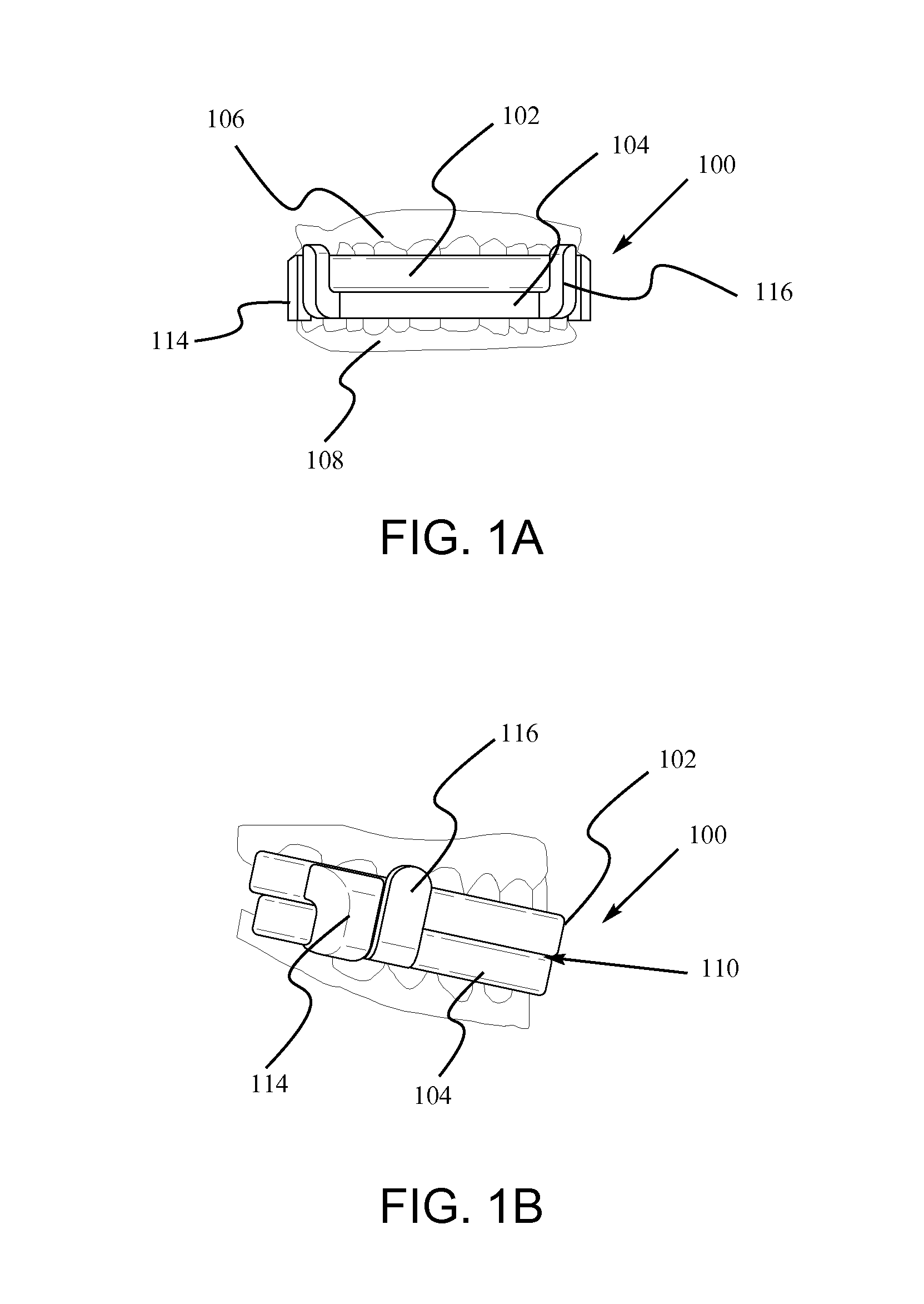 Mandibular advancement device