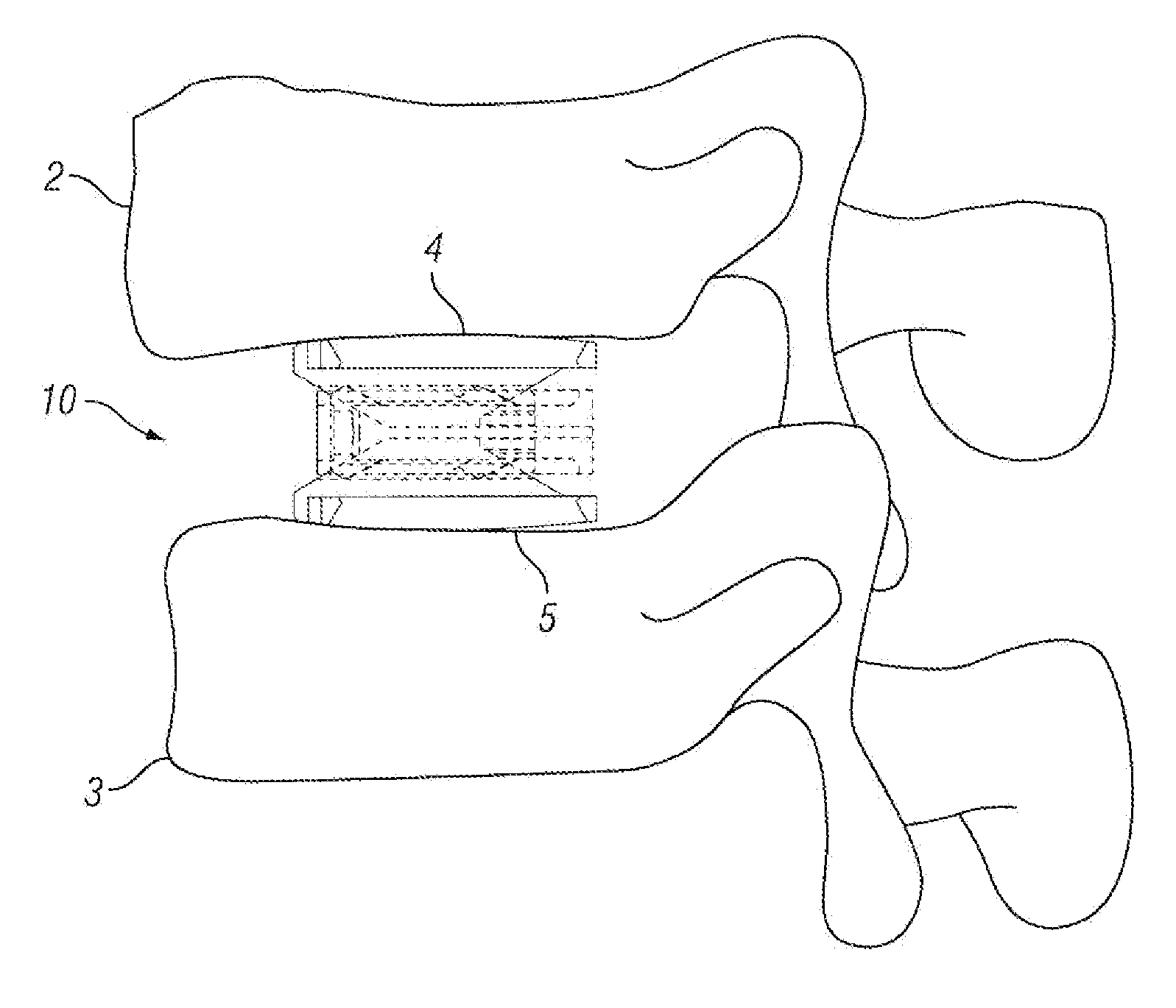 Expandable Fusion Device and Method of Installation Thereof