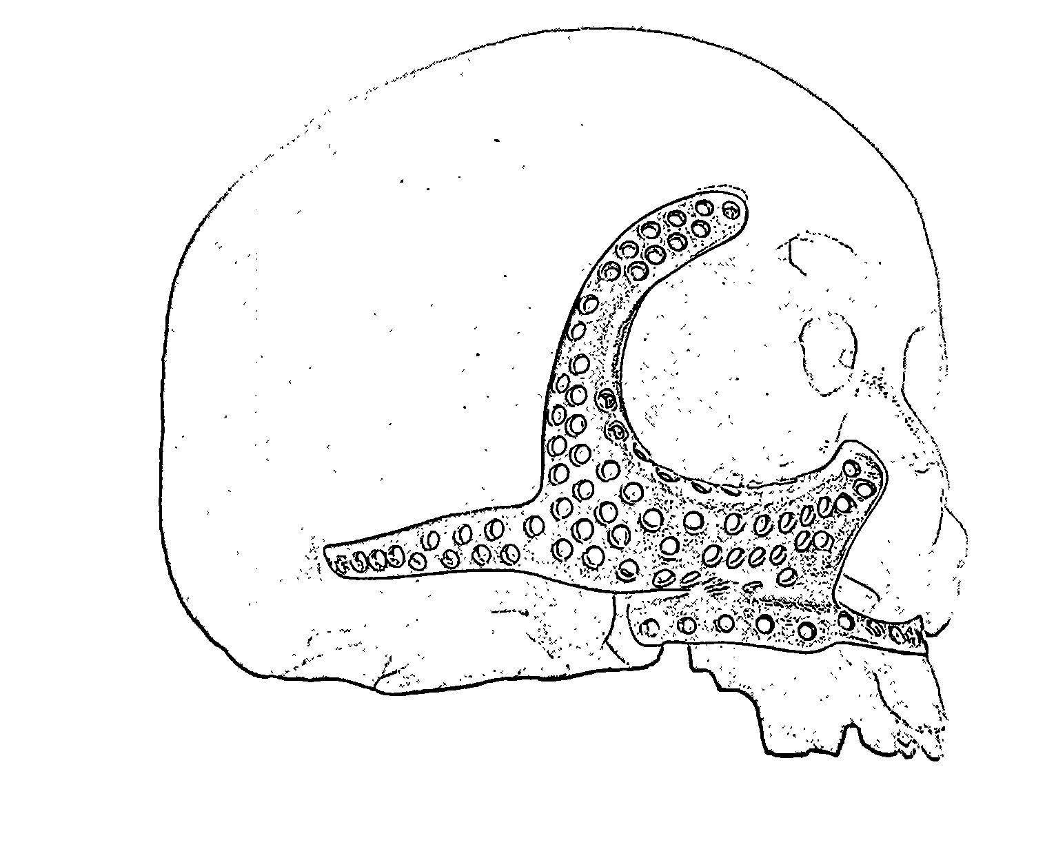 Integral repair stent of eye sockets, cheekbones and maxillary bone and manufacturing method thereof