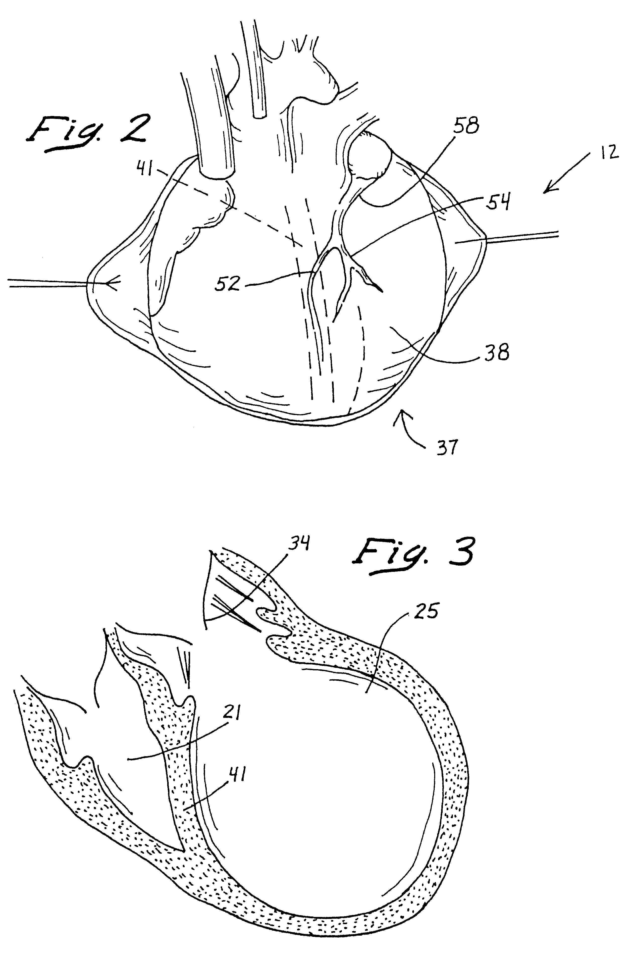 Ventricular restoration patch