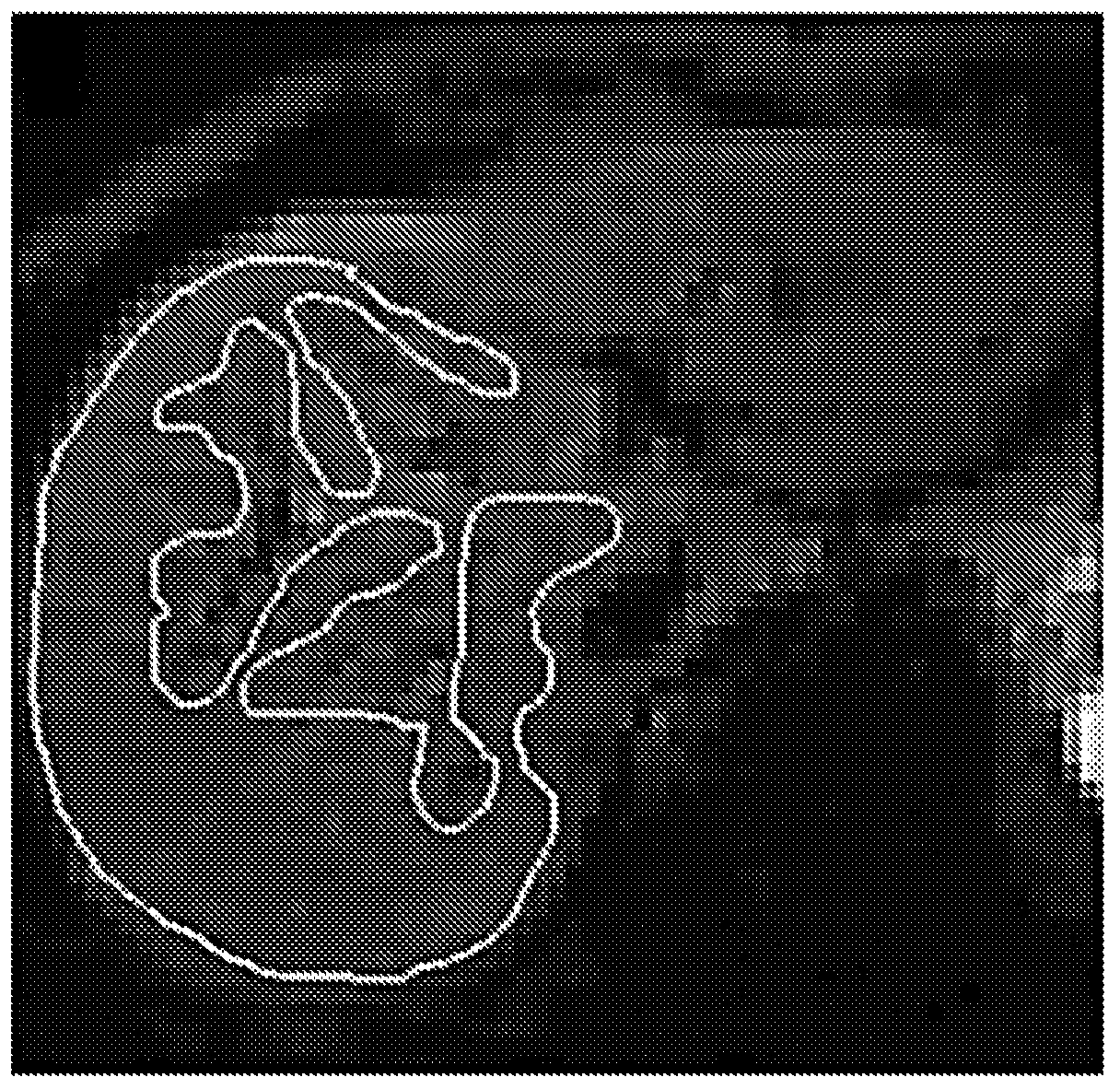 Intravoxel incoherent motion MRI 3-dimensional quantitative detection of tissue abnormality with improved data processing