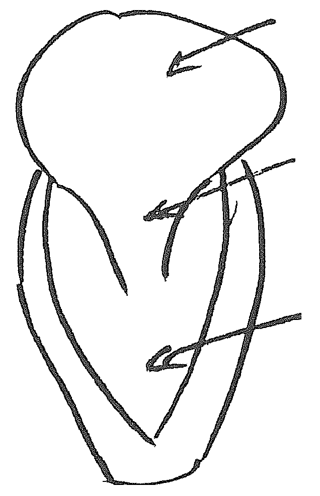 Device and method for reducing cardiac valve regurgitation