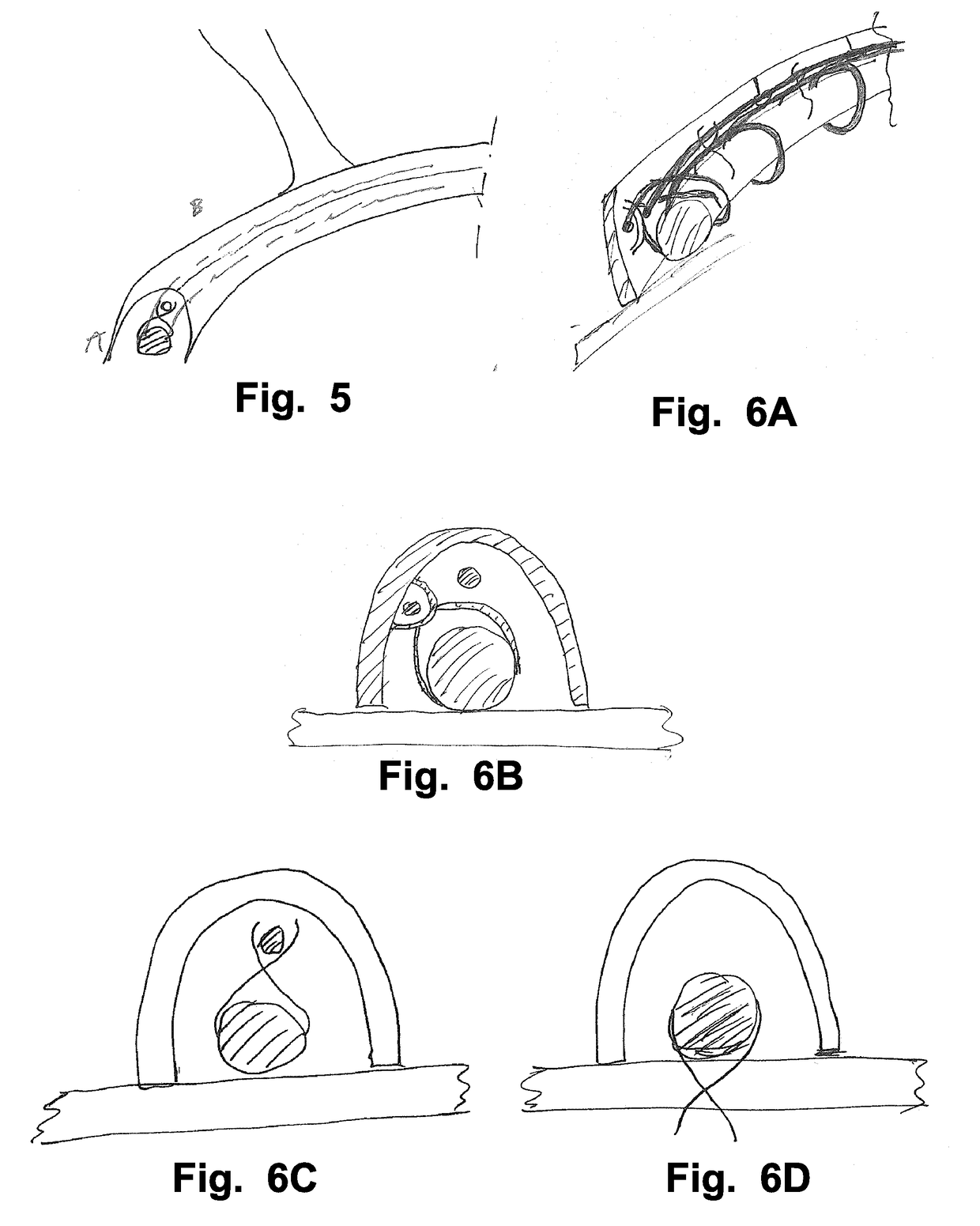 Device and method for reducing cardiac valve regurgitation