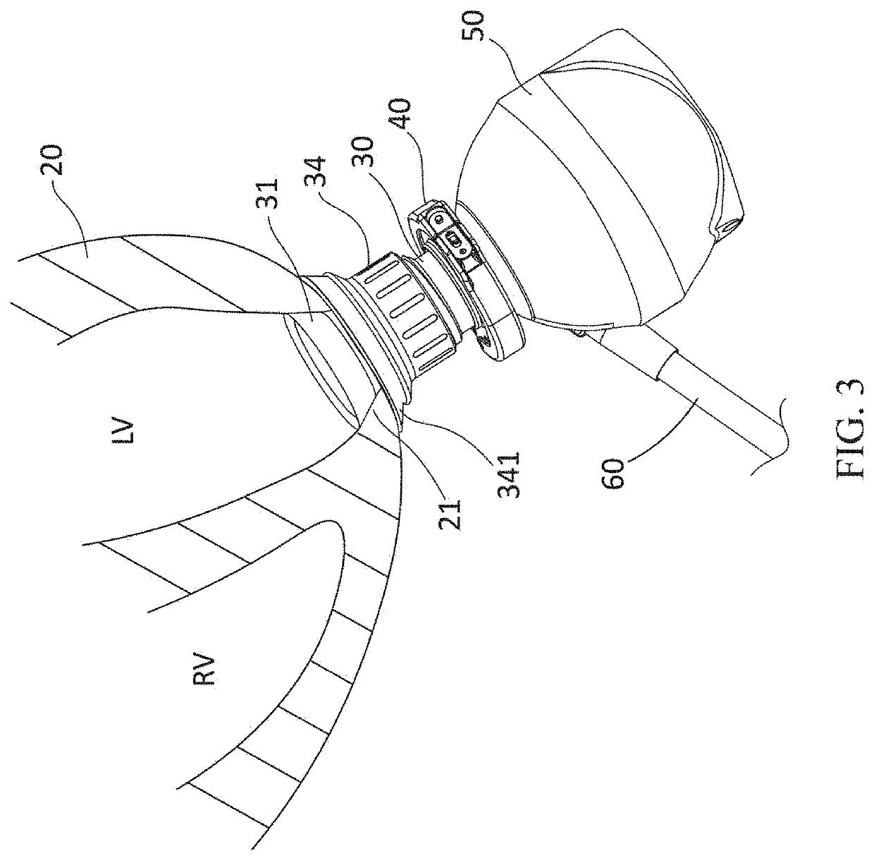 Implantable co-pulsatile epi-ventricular circulatory support system with sutureless flow cannula assembly