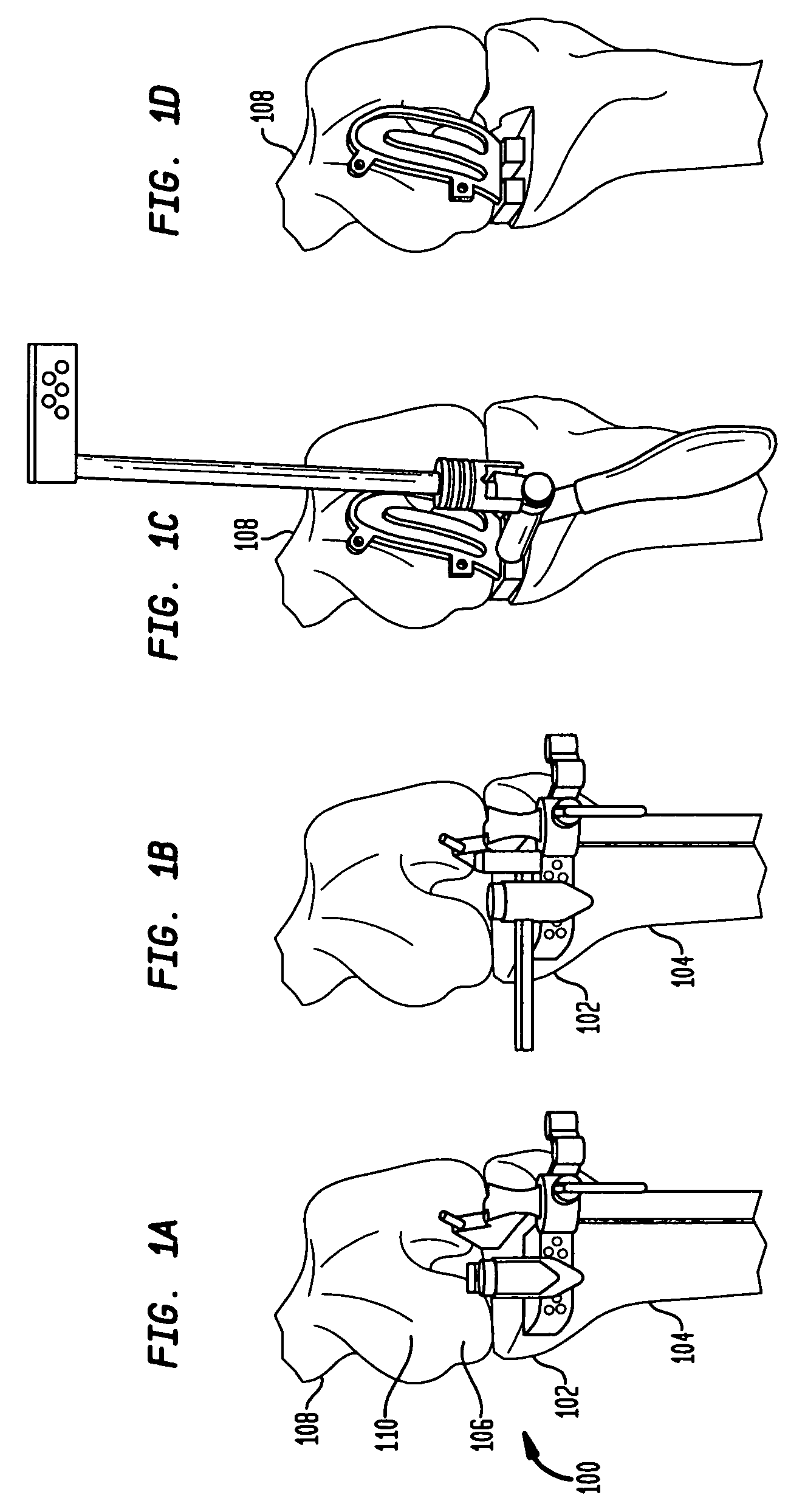 Unicondylar knee implants and insertion methods therefor