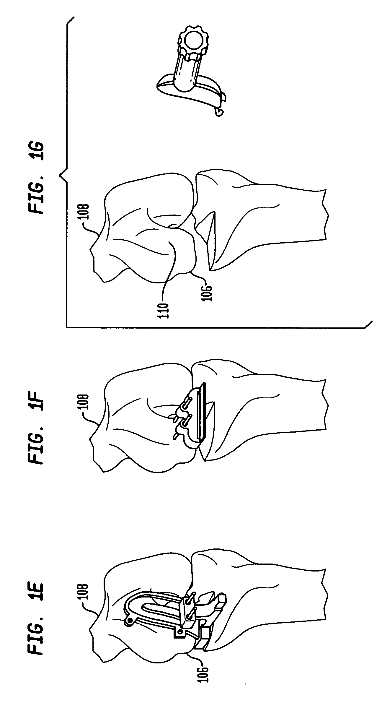 Unicondylar knee implants and insertion methods therefor