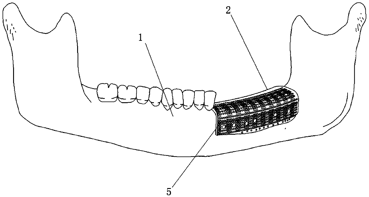 Three-dimensional printed titanium mesh implant with osteogenic induction coating