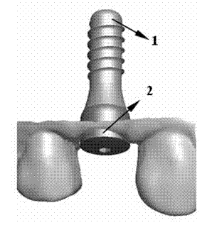 Implant denture individual abutment design method based on healing abutment dental model