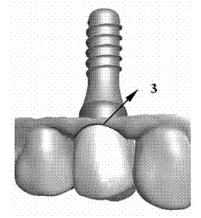 Implant denture individual abutment design method based on healing abutment dental model