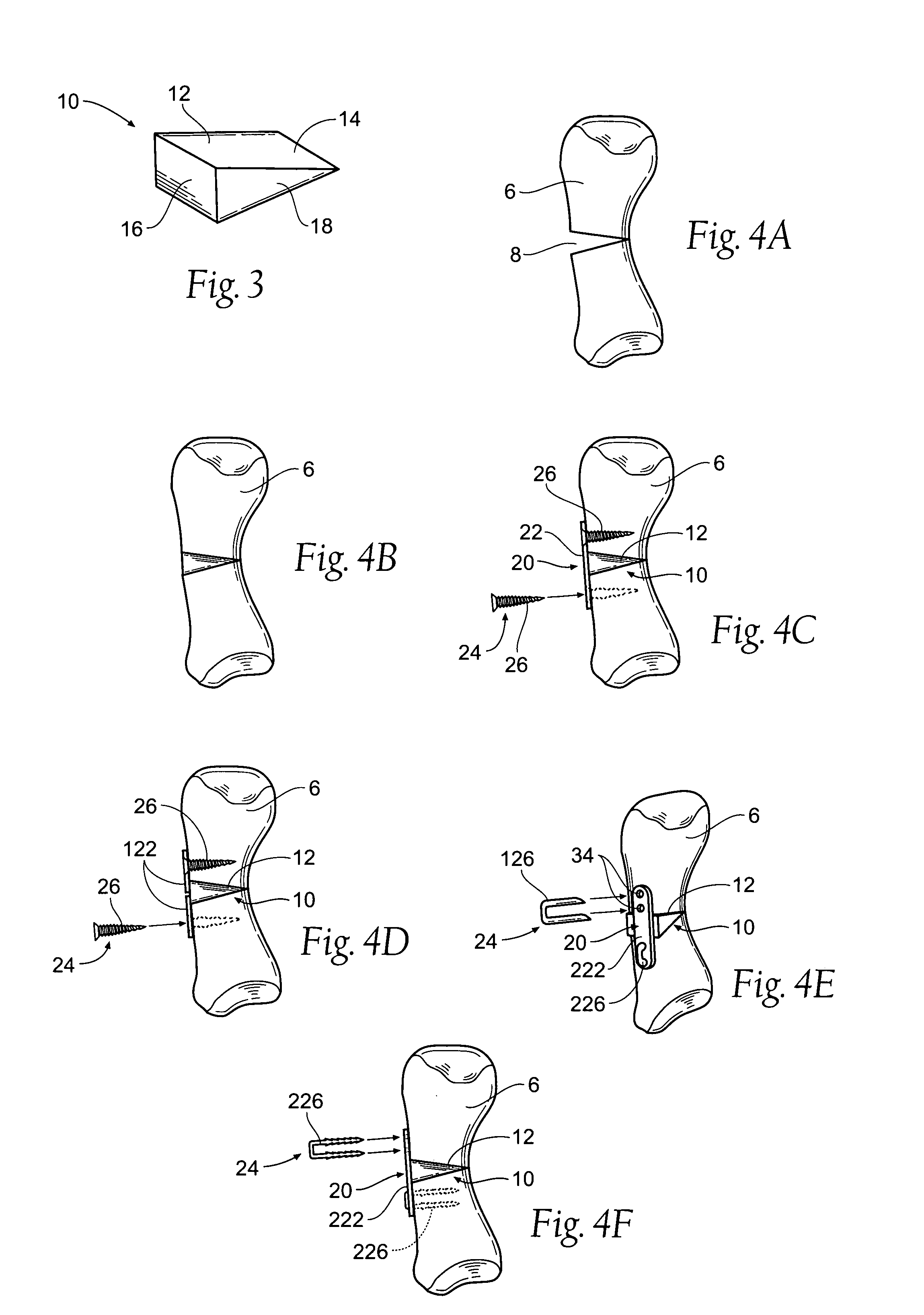 Devices, systems and methods for re-alignment of bone