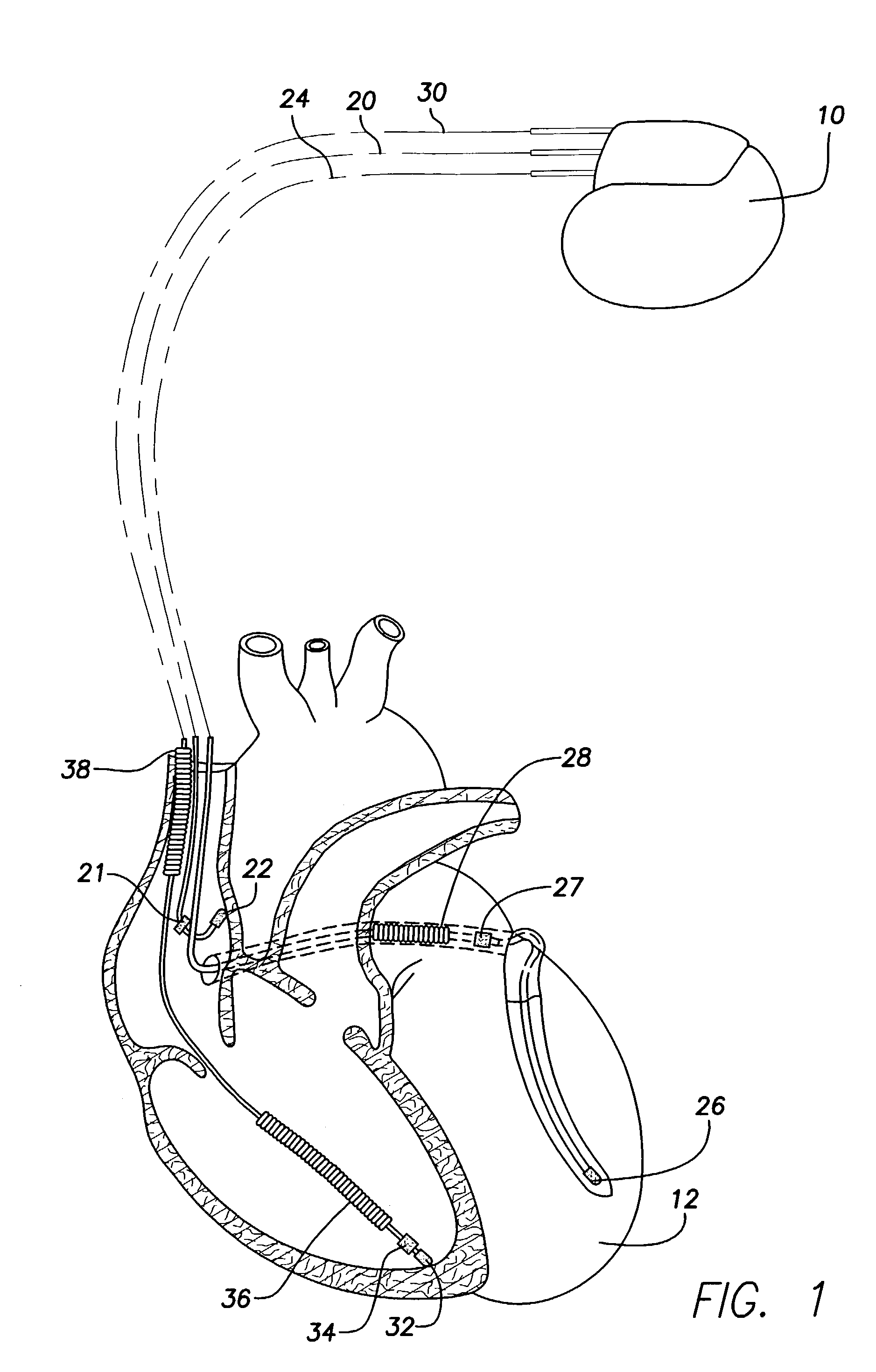 Implantable cardiac stimulation system providing capture threshold stability assessment and method