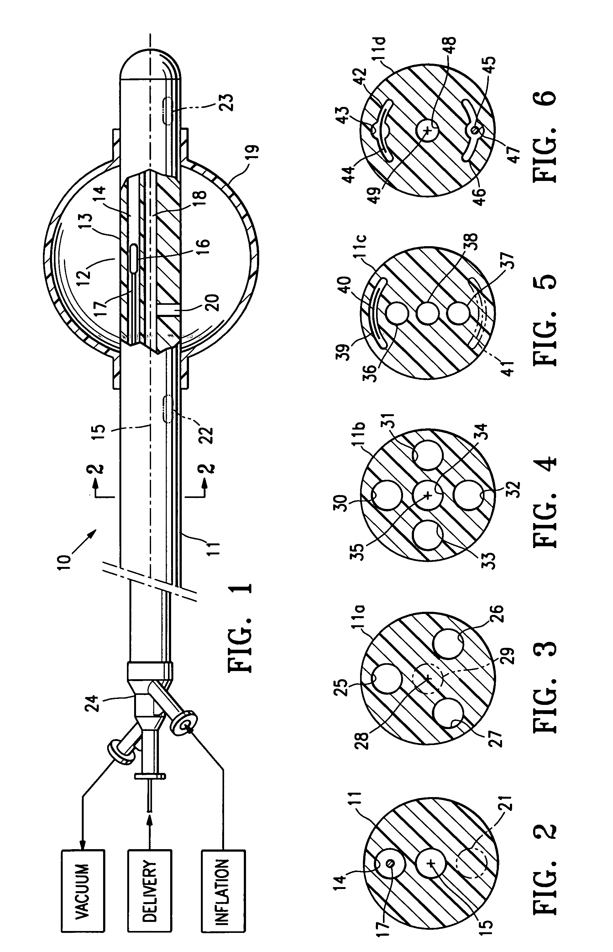 Asymmetrical irradiation of a body cavity