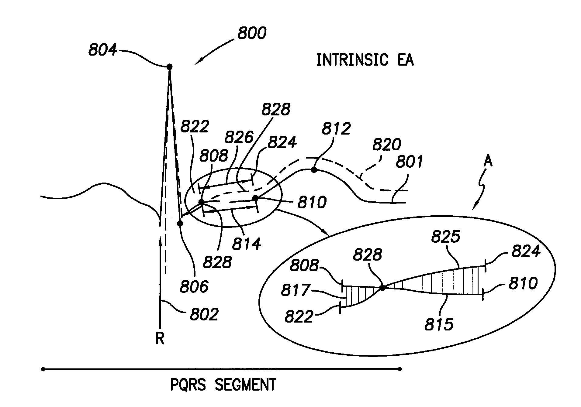 Method and system for automatically calibrating ischemia detection parameters