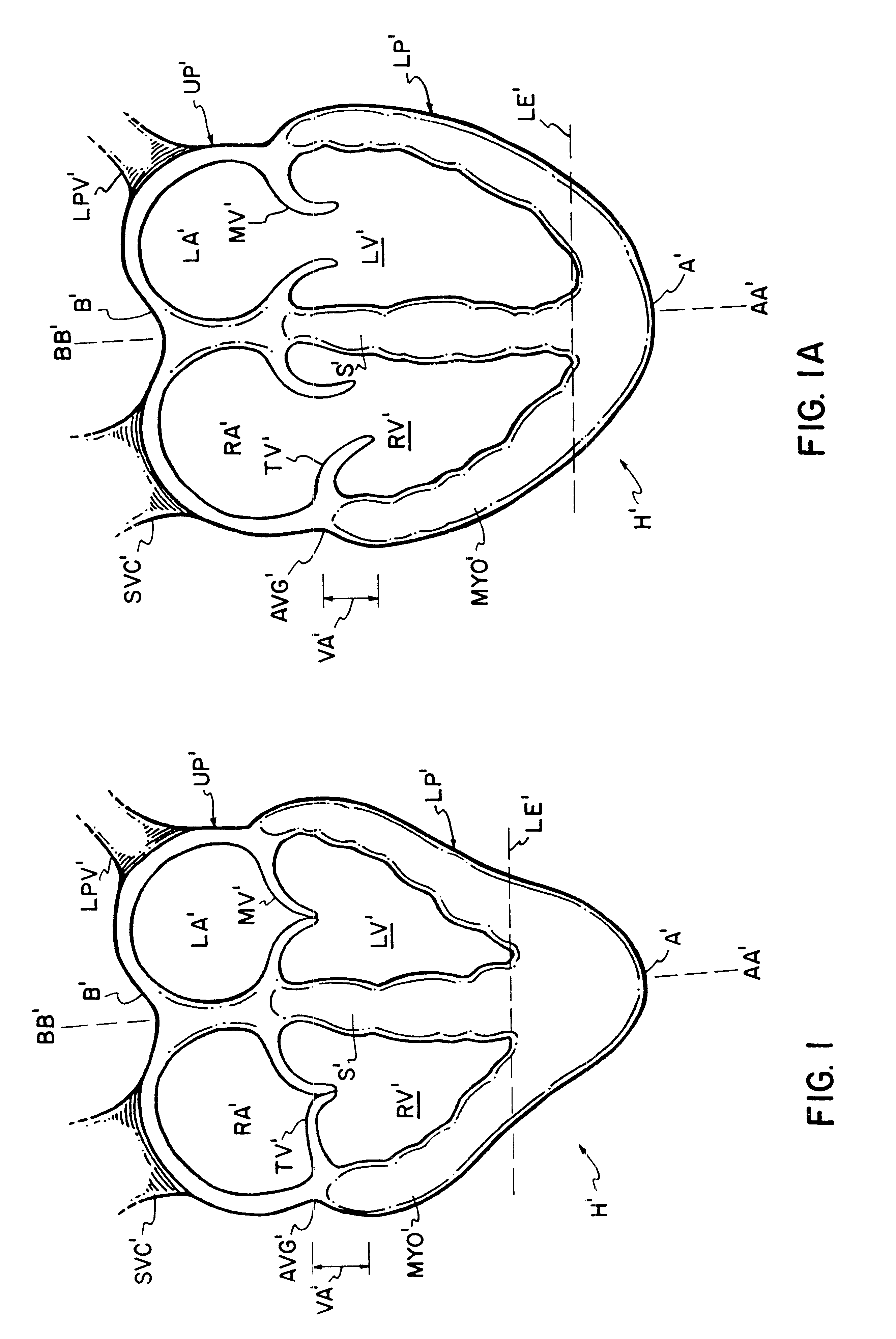 Defibrillating cardiac constraint