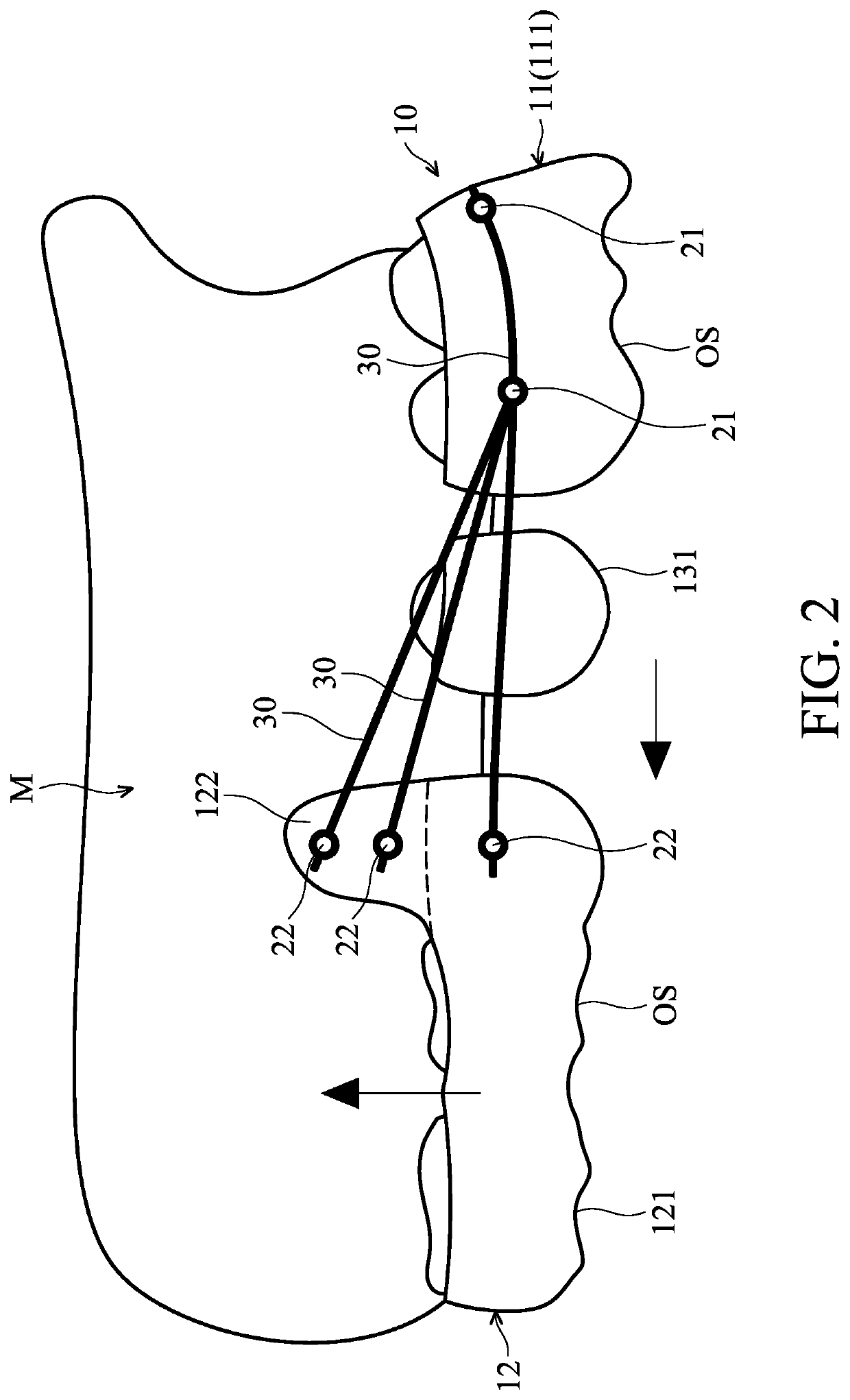 Orthodontic space closure device