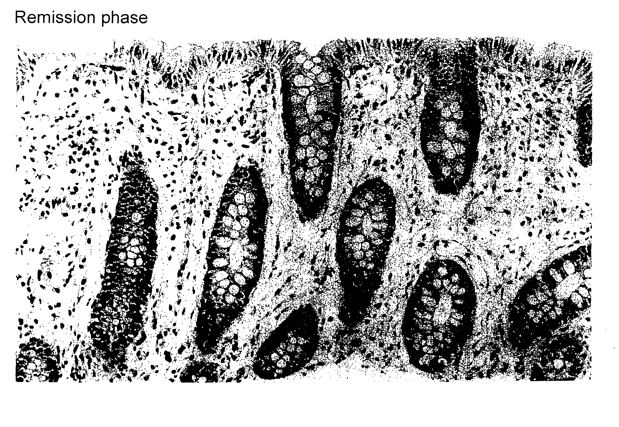 Method for clinical staging of ulcerative colitis or interstitial pneumonia and reagent kit for the same