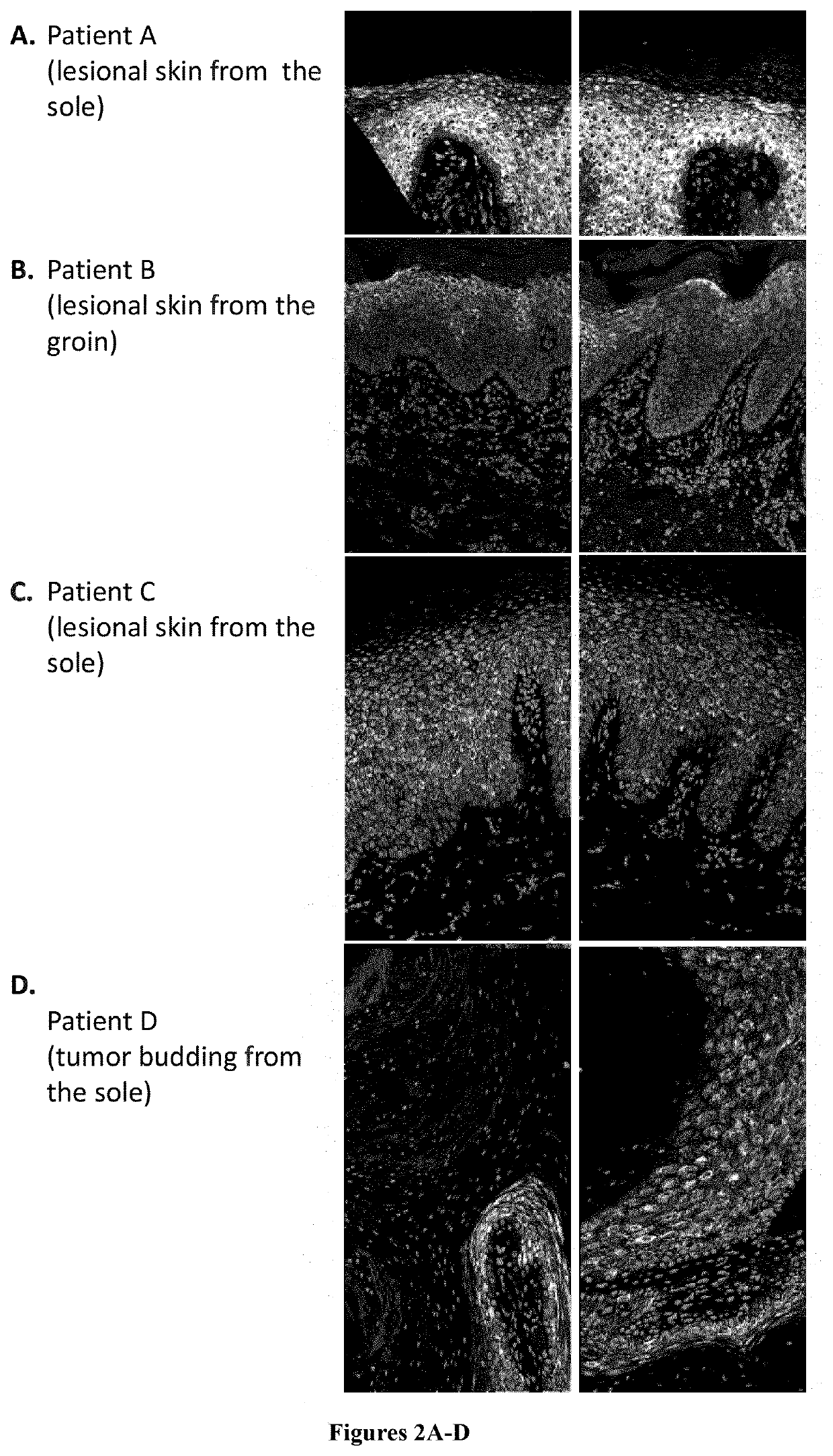 Methods and pharmaceutical compositions for the treatment of olmsted syndrome