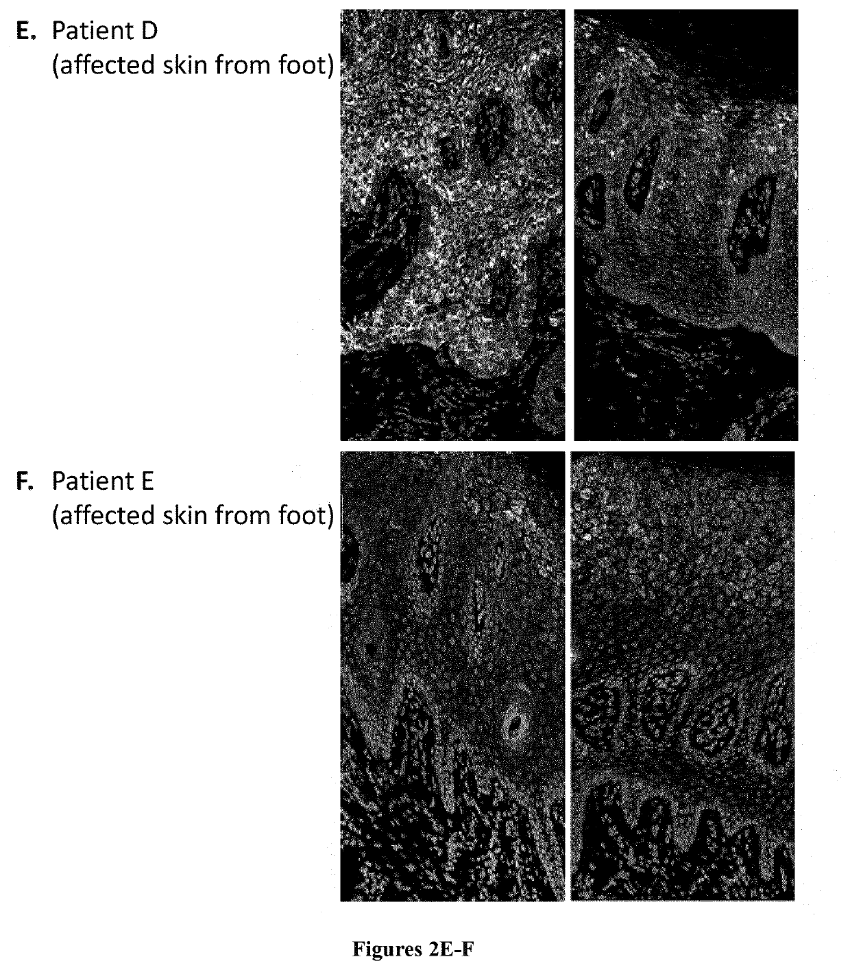 Methods and pharmaceutical compositions for the treatment of olmsted syndrome