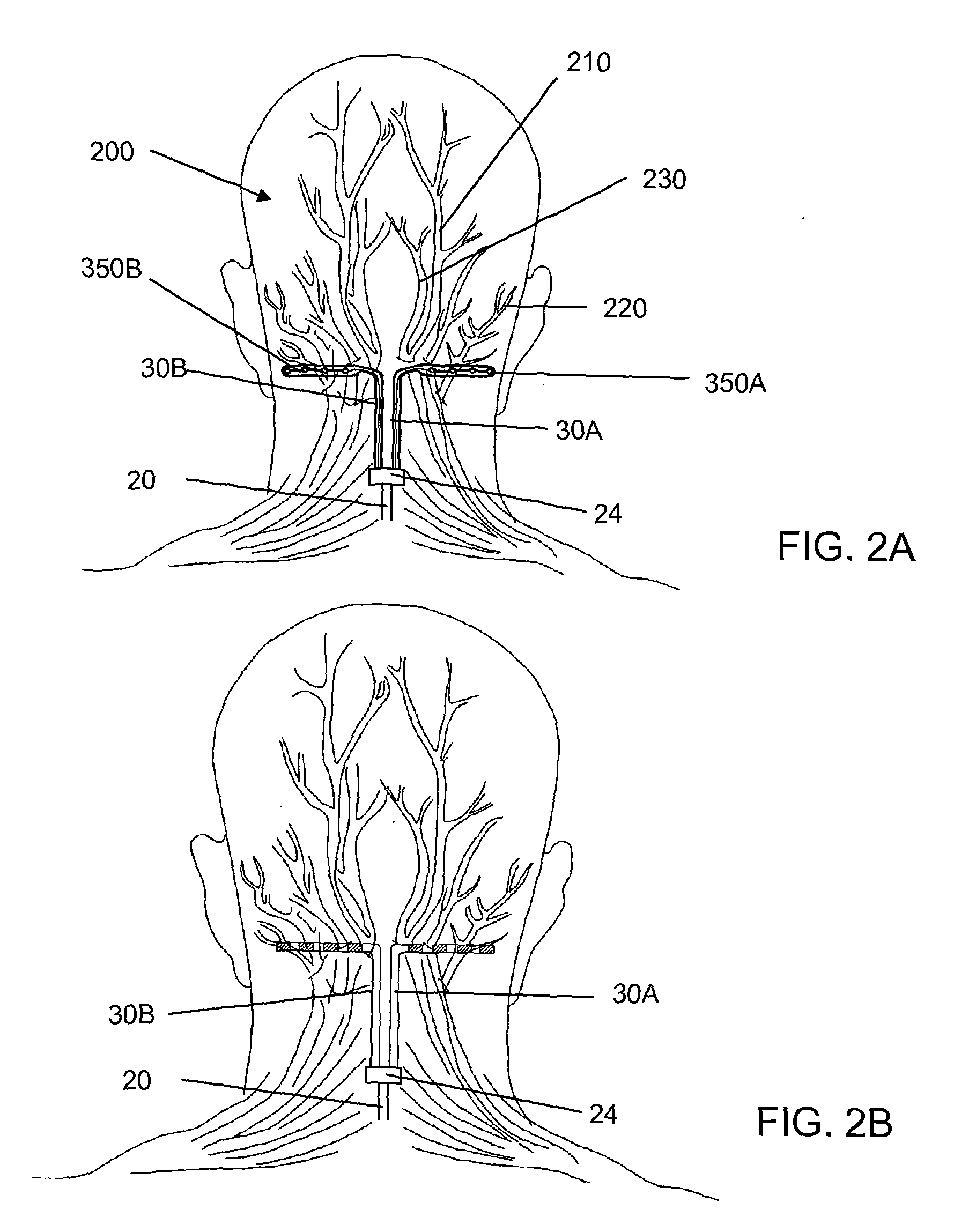 Lead extension having connector configured to receive two leads