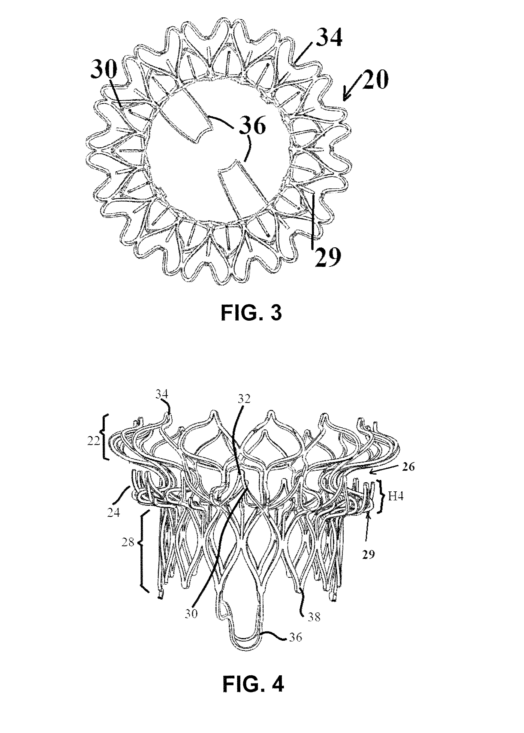 Device and Method for Mitral Valve Regurgitation Treatment