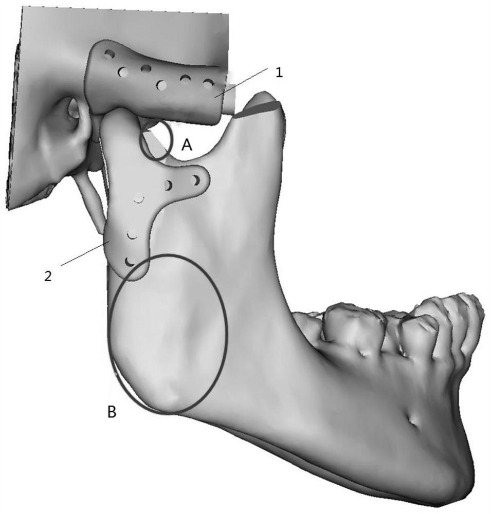 Muscle function preservation type all-temporal lower joint prosthesis