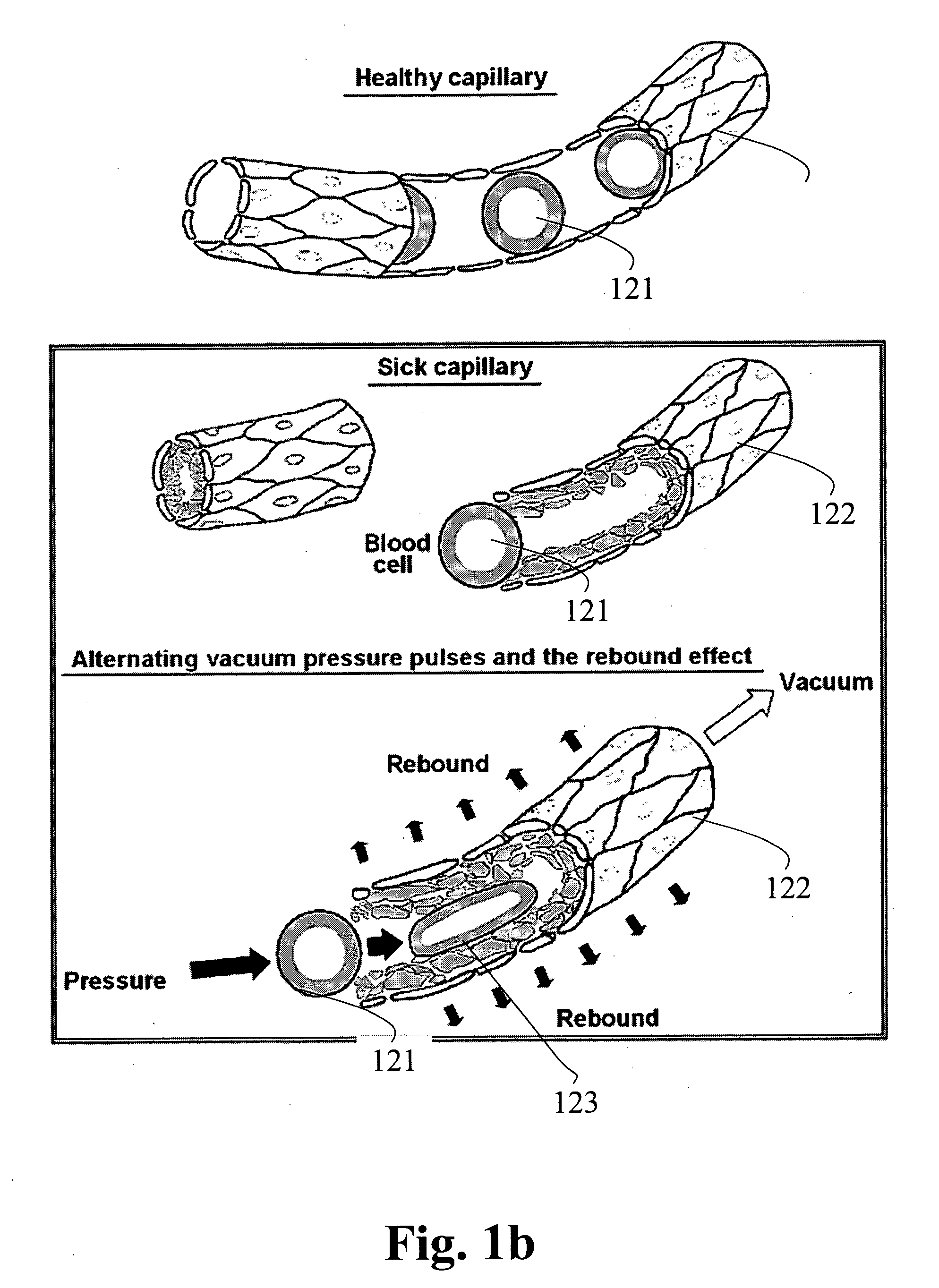 Devices for functional revascularization by alternating pressure