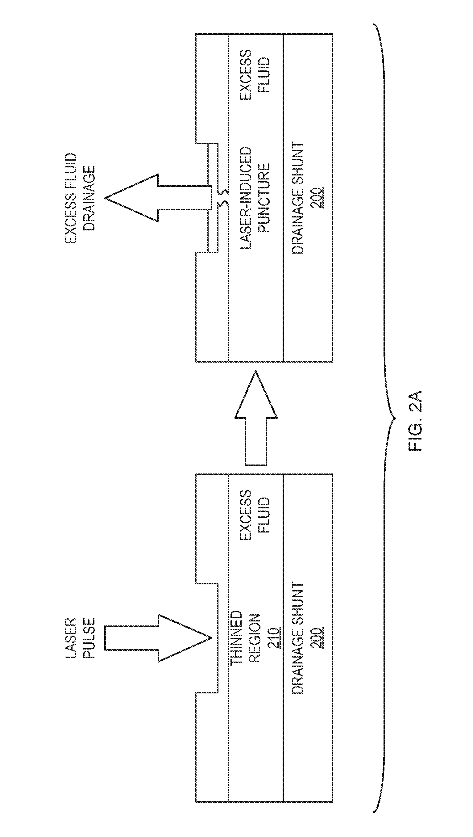 Implantable Intraocular Pressure Drain