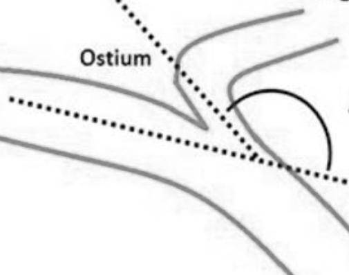 Spherical double-cavity micro-catheter