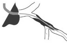 Spherical double-cavity micro-catheter