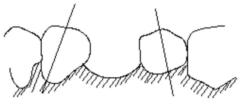 Use method of dental suppository channel type attachment