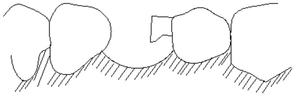 Use method of dental suppository channel type attachment