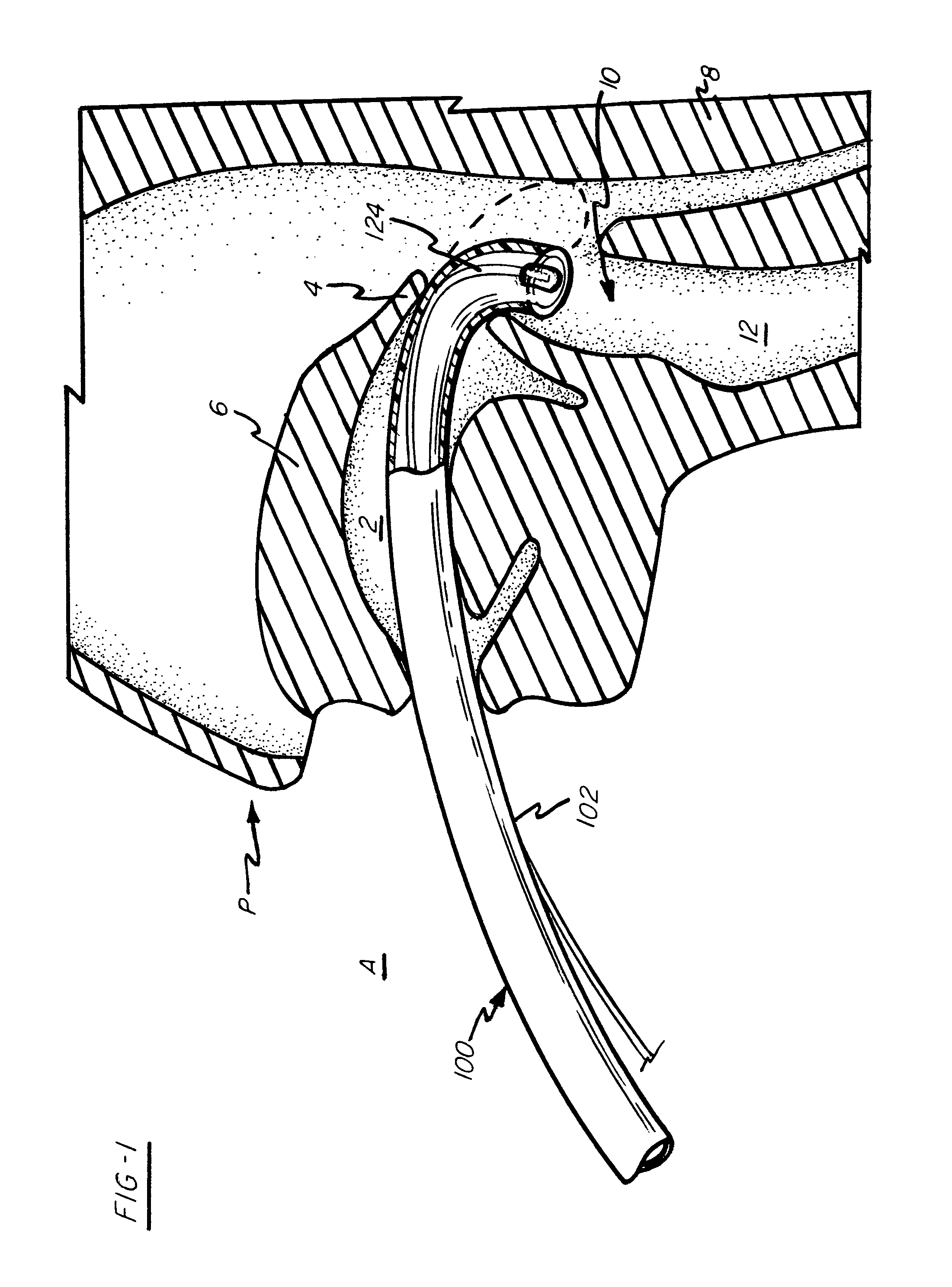 Intubation device