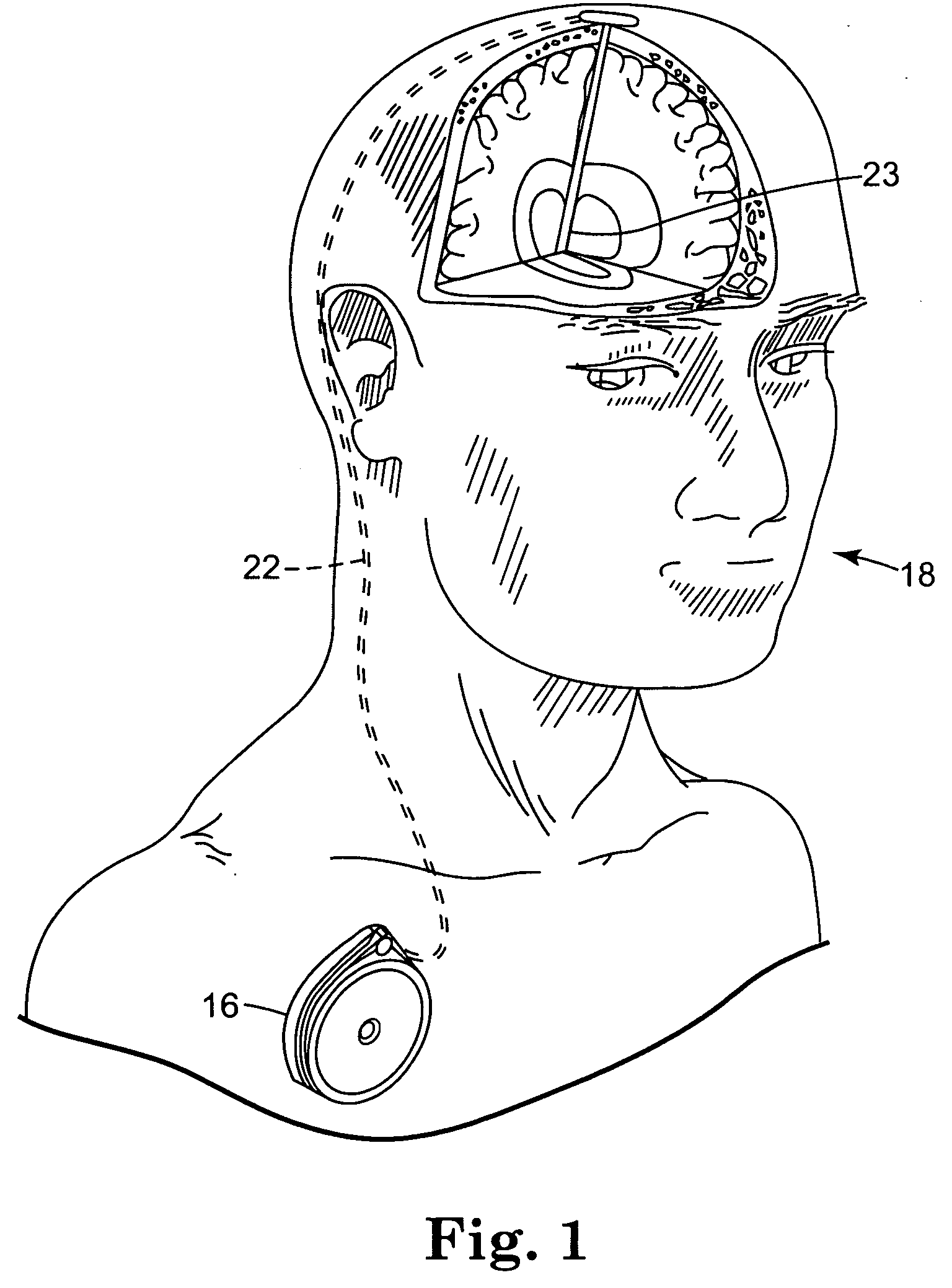 Inductively rechargeable external energy source, charger, system and method for a transcutaneous inductive charger for an implantable medical device