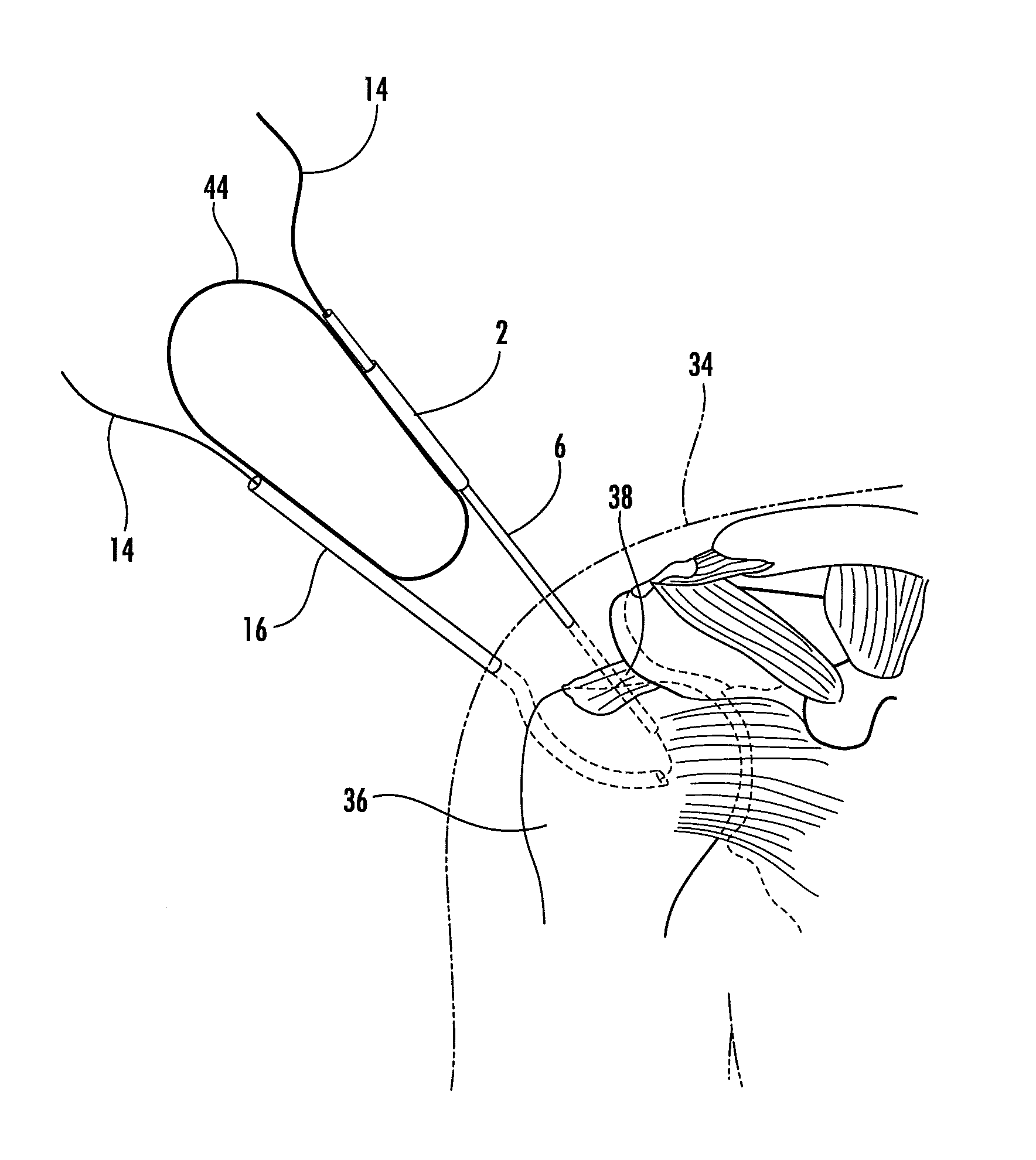 Suture Passer and Subcortical Knot Placement