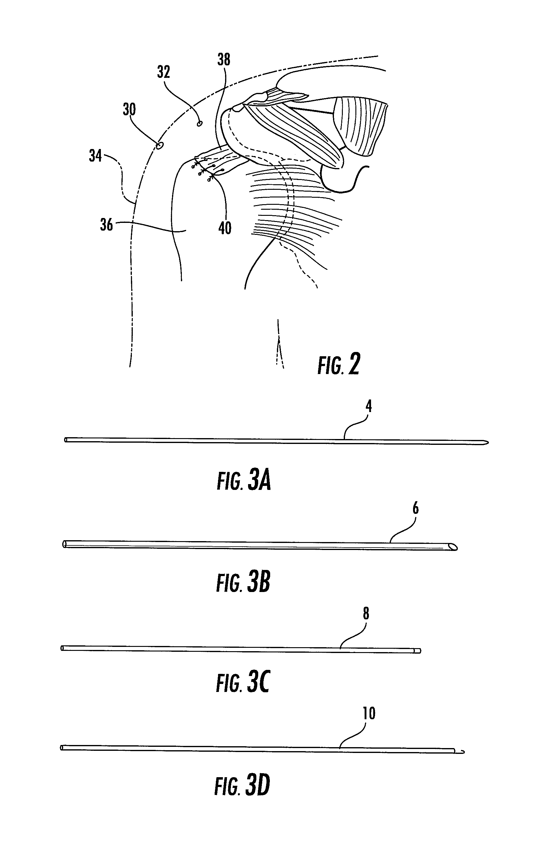 Suture Passer and Subcortical Knot Placement