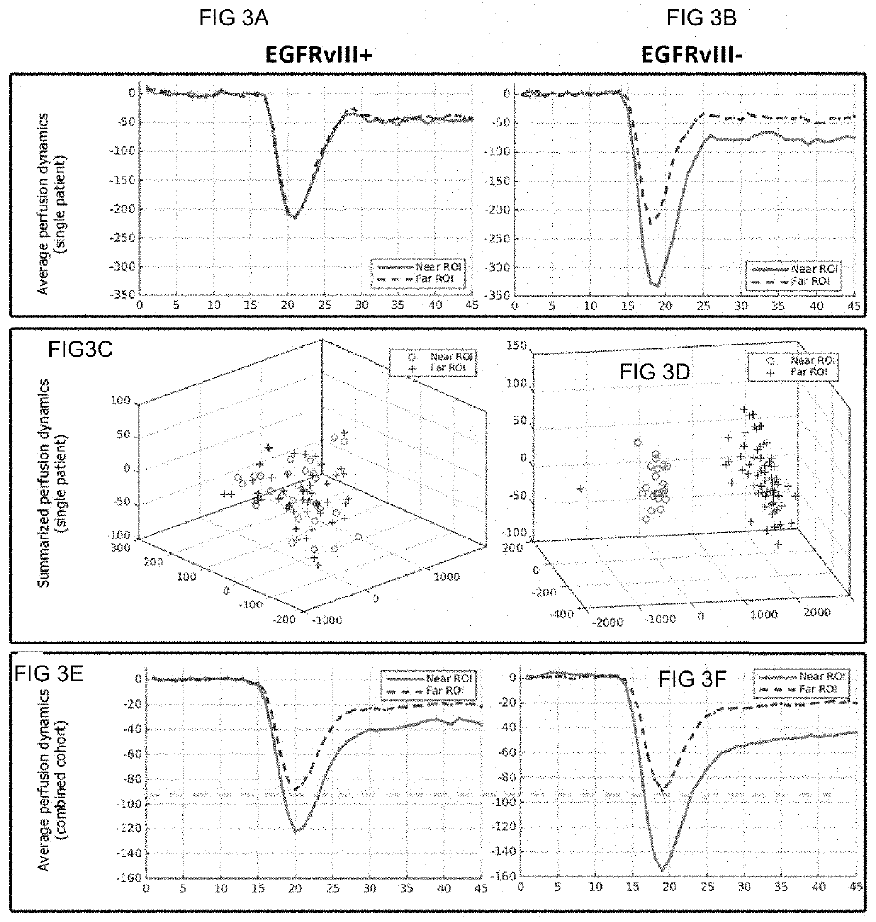 In vivo detection of EGFR mutation in glioblastoma via MRI signature consistent with deep peritumoral infiltration