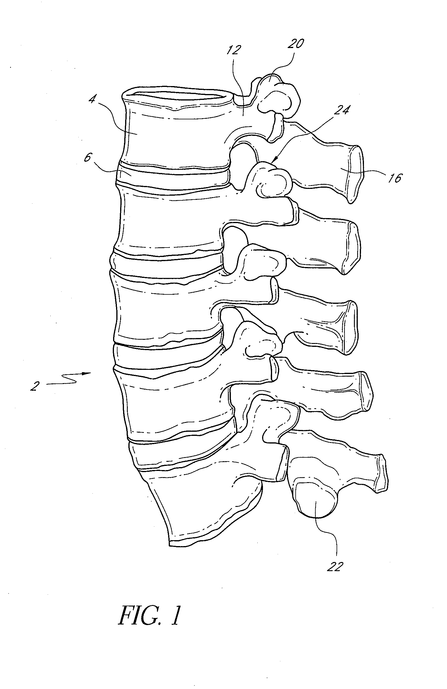 Vertebral facet joint prosthesis and method of fixation