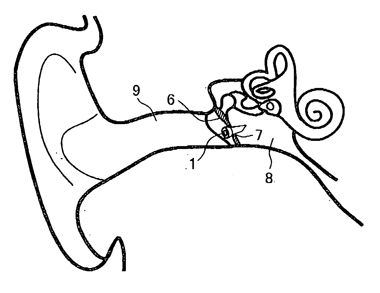 Tympanic membrane drain tube