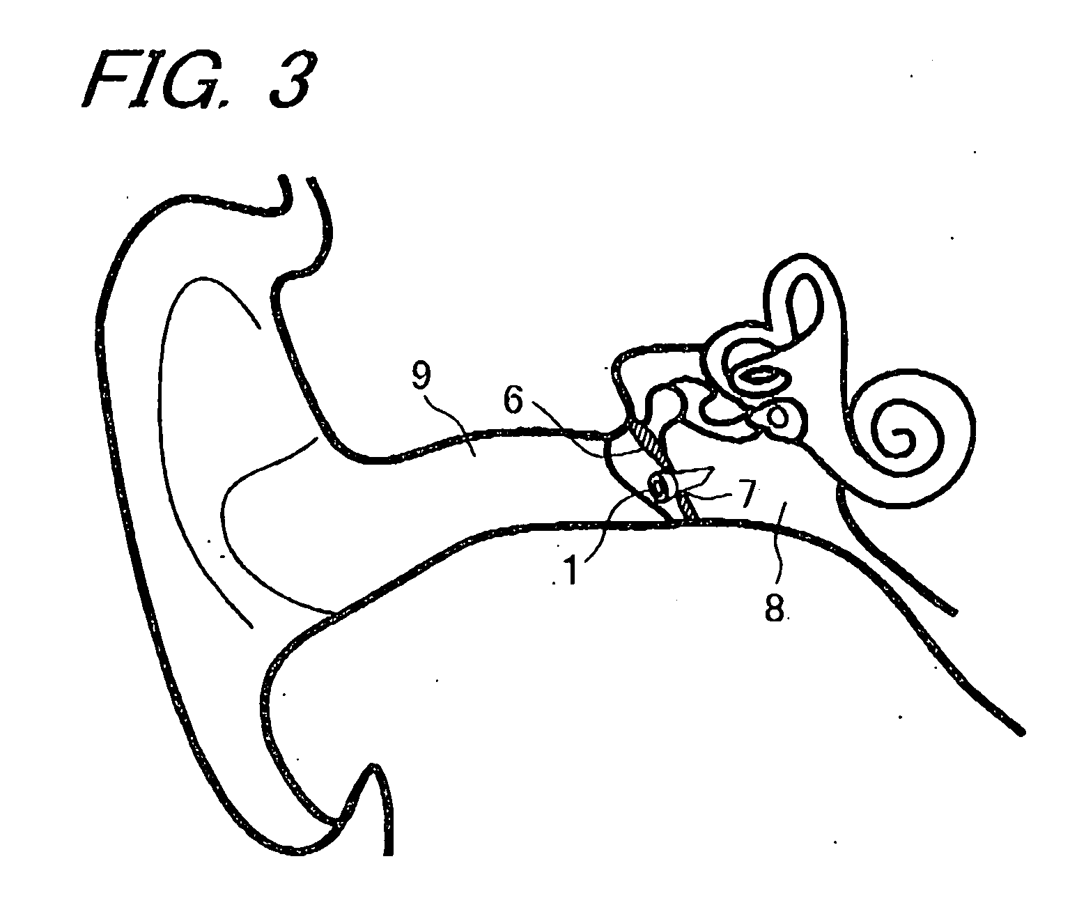 Tympanic membrane drain tube