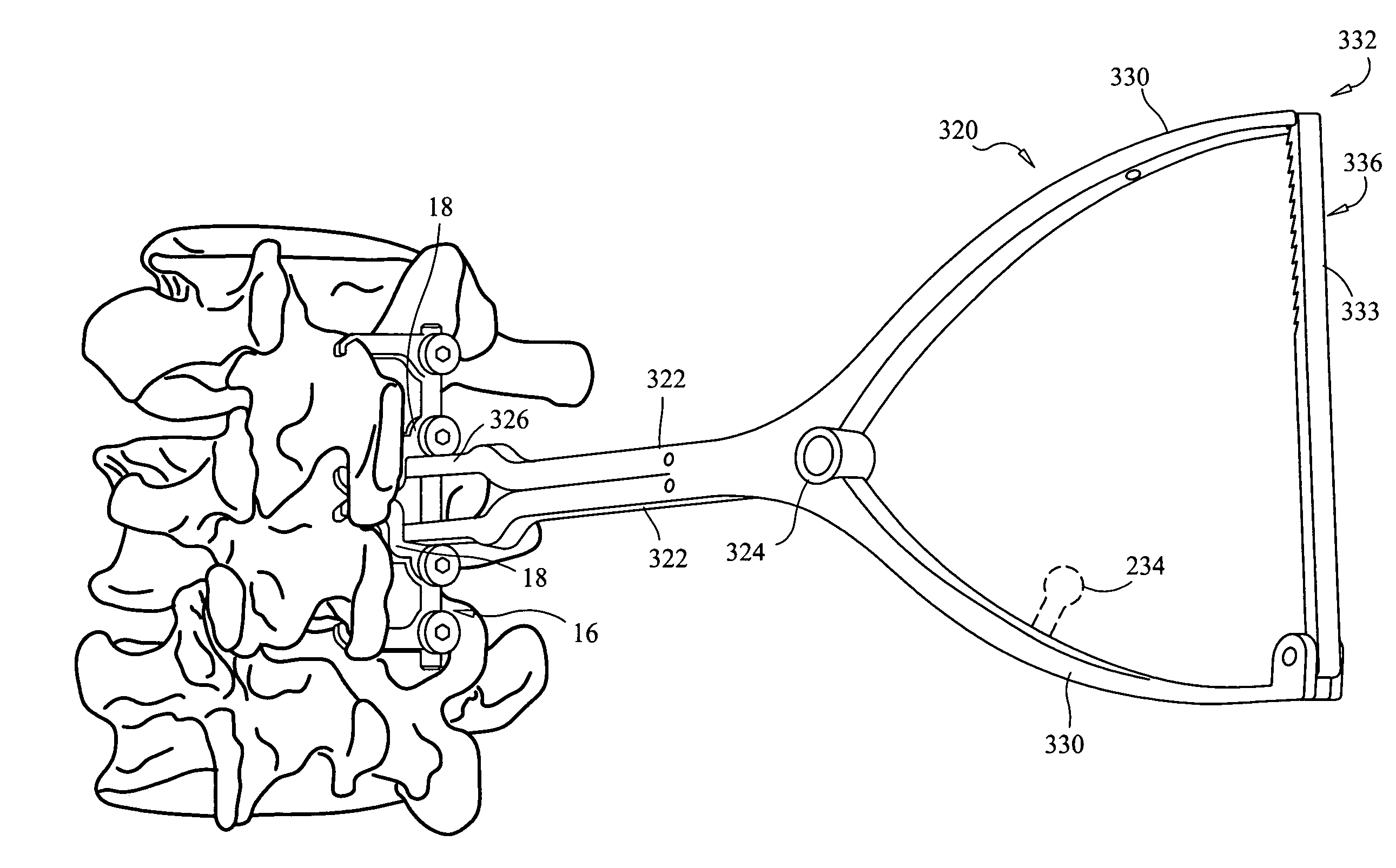 Interspinous implant, tools and methods of implanting